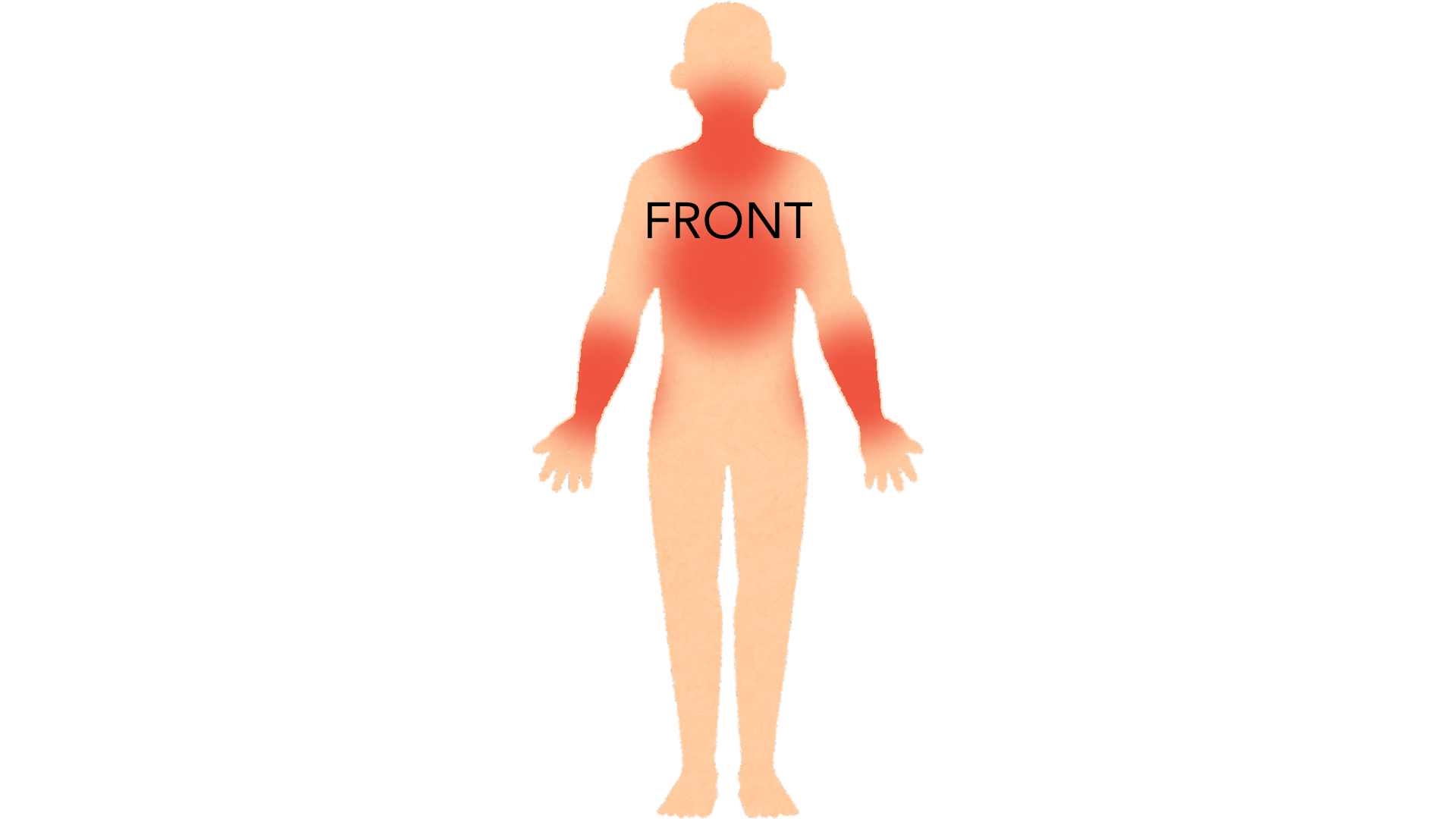 Front view of a whole body with red marks on both forearms, on the front of the neck and across the upper chest.