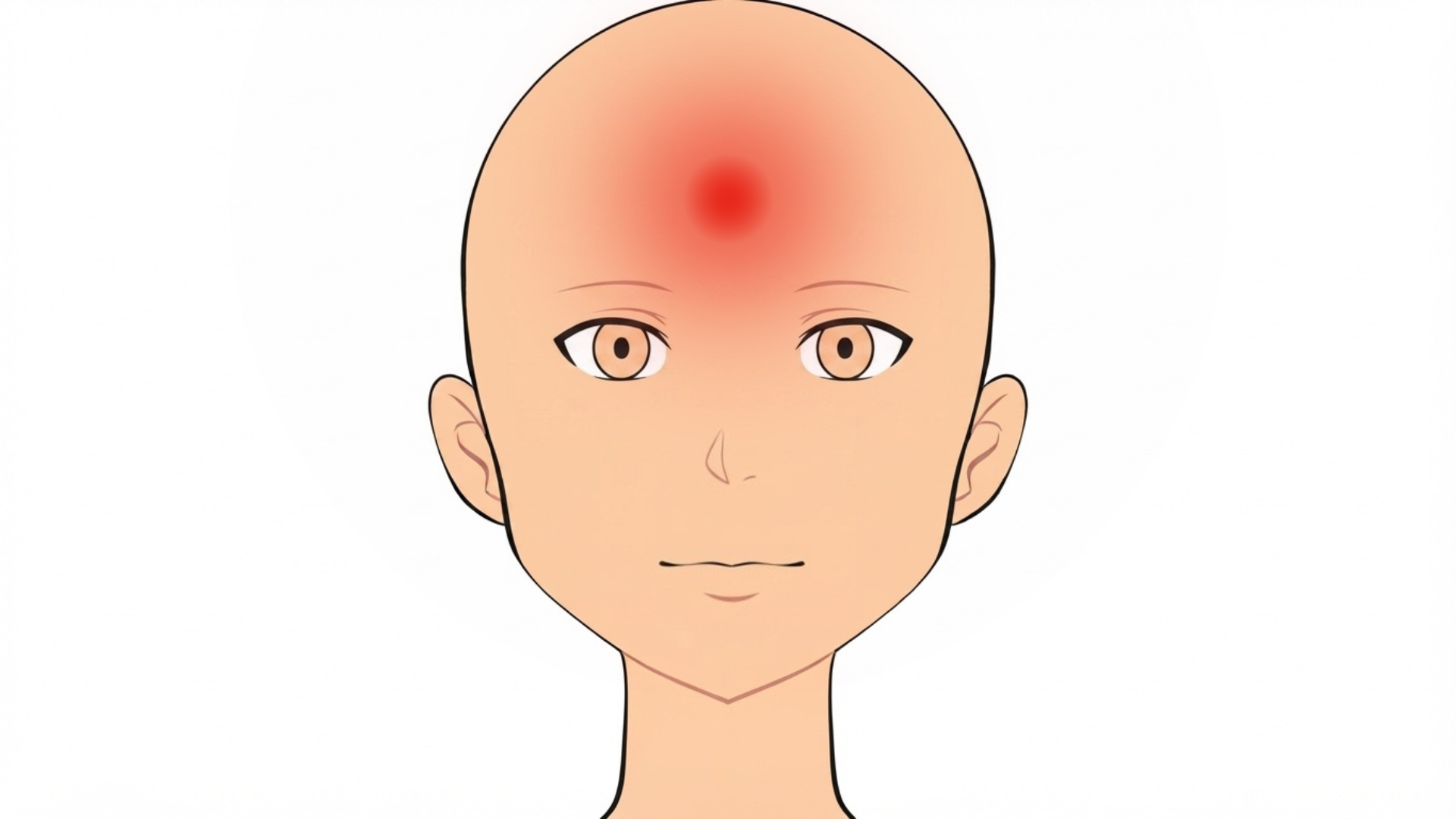 Front view of a face with soft brown patches across both sides of the forehead and above the brows. The rest of the face is clear.