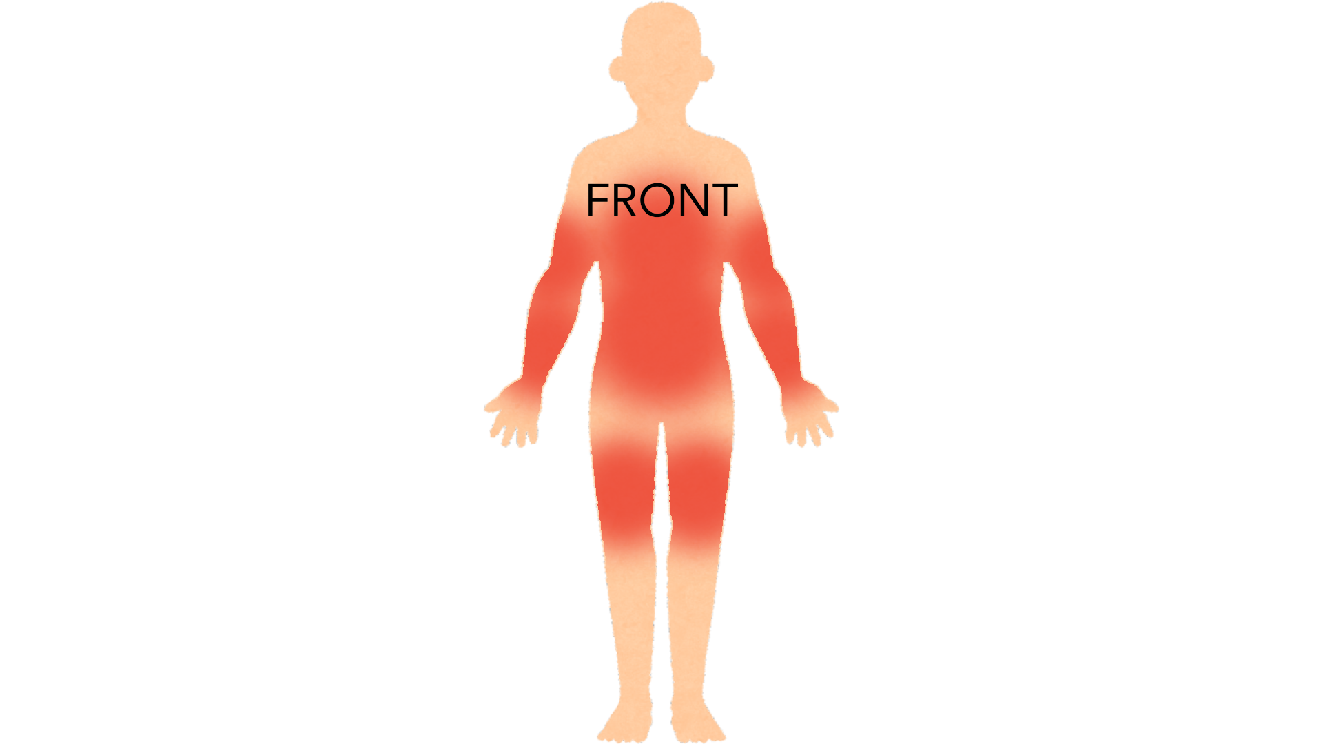 Front view of a whole body with red marks on both arms, across the chest and abdomen and on both thighs.