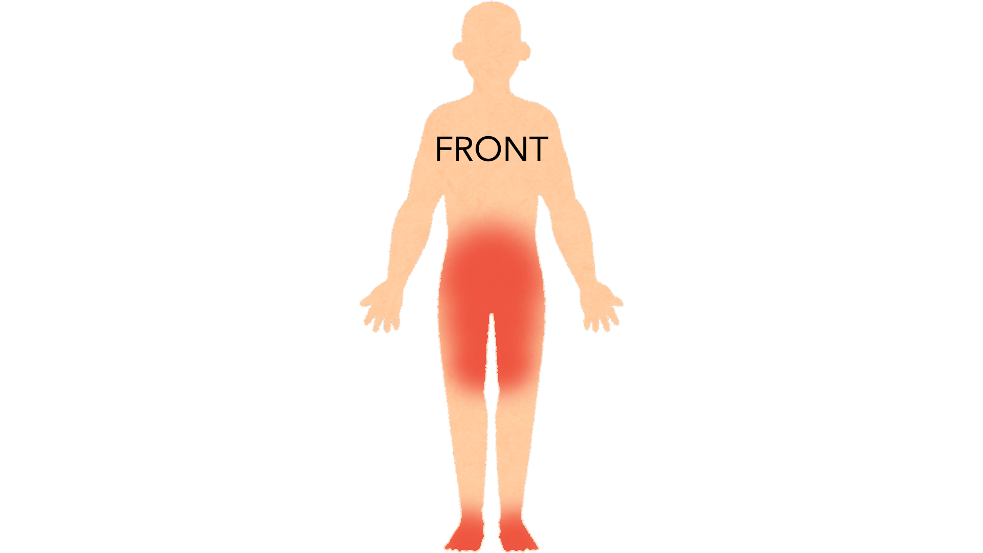 Front view of a whole body with red marks across the groin and inner thighs, around the waistline and on both feet.