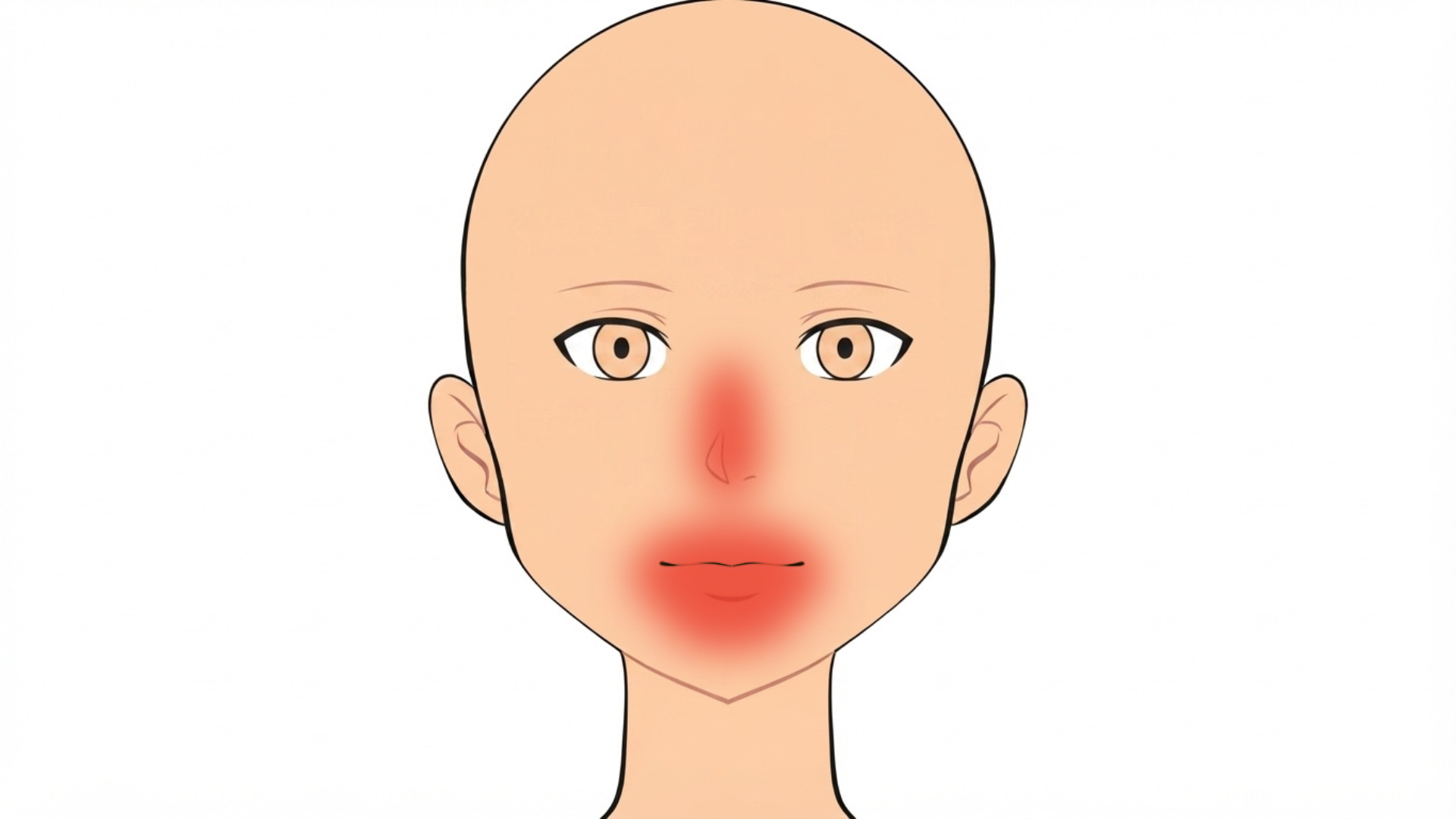 Front view of a head with red marks along the upper and lower lip, at both corners of the mouth, at the base of the nose and on the chin.