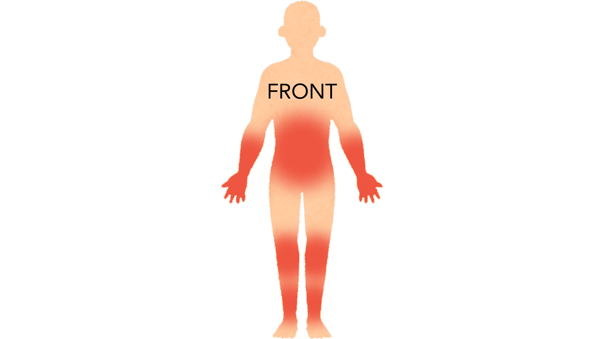 Front view of a whole body with red marks on both hands and forearms, on both knees and shins and across the abdomen.