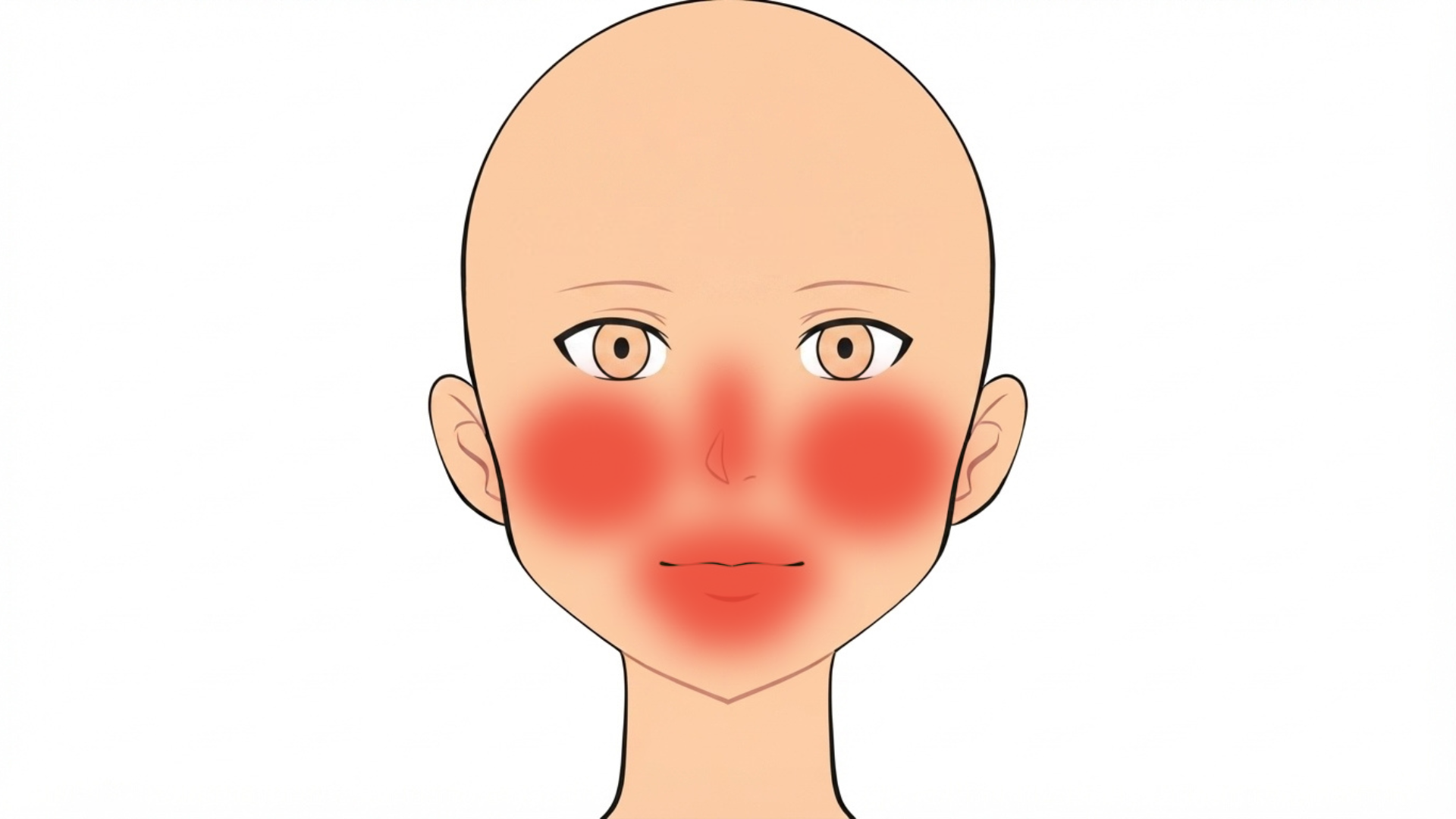 Front view of a head with red marks around the nose, on the upper and lower lip, at both corners of the mouth, on the chin and on both cheeks.