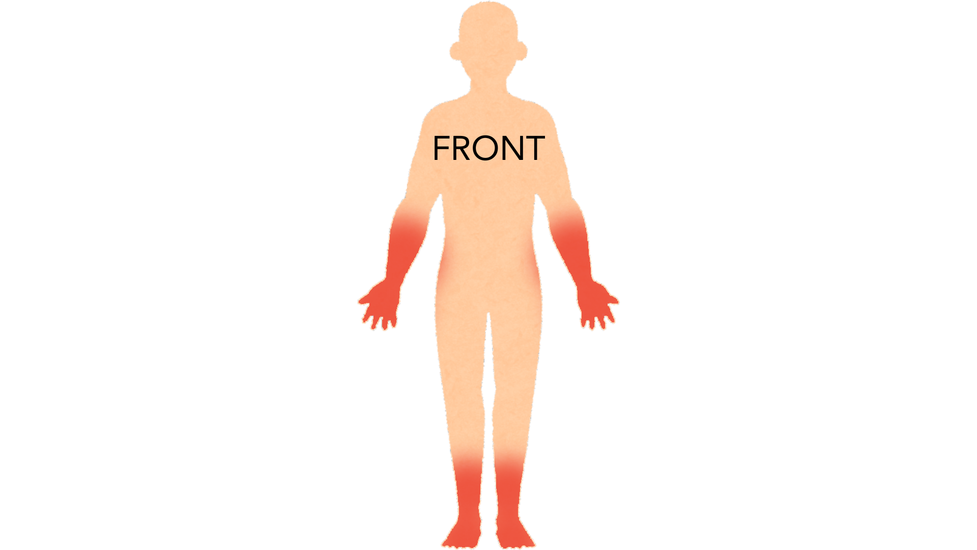 Front view of a whole body with red marks on the backs of both hands, on both forearms, down both shins and on both feet.
