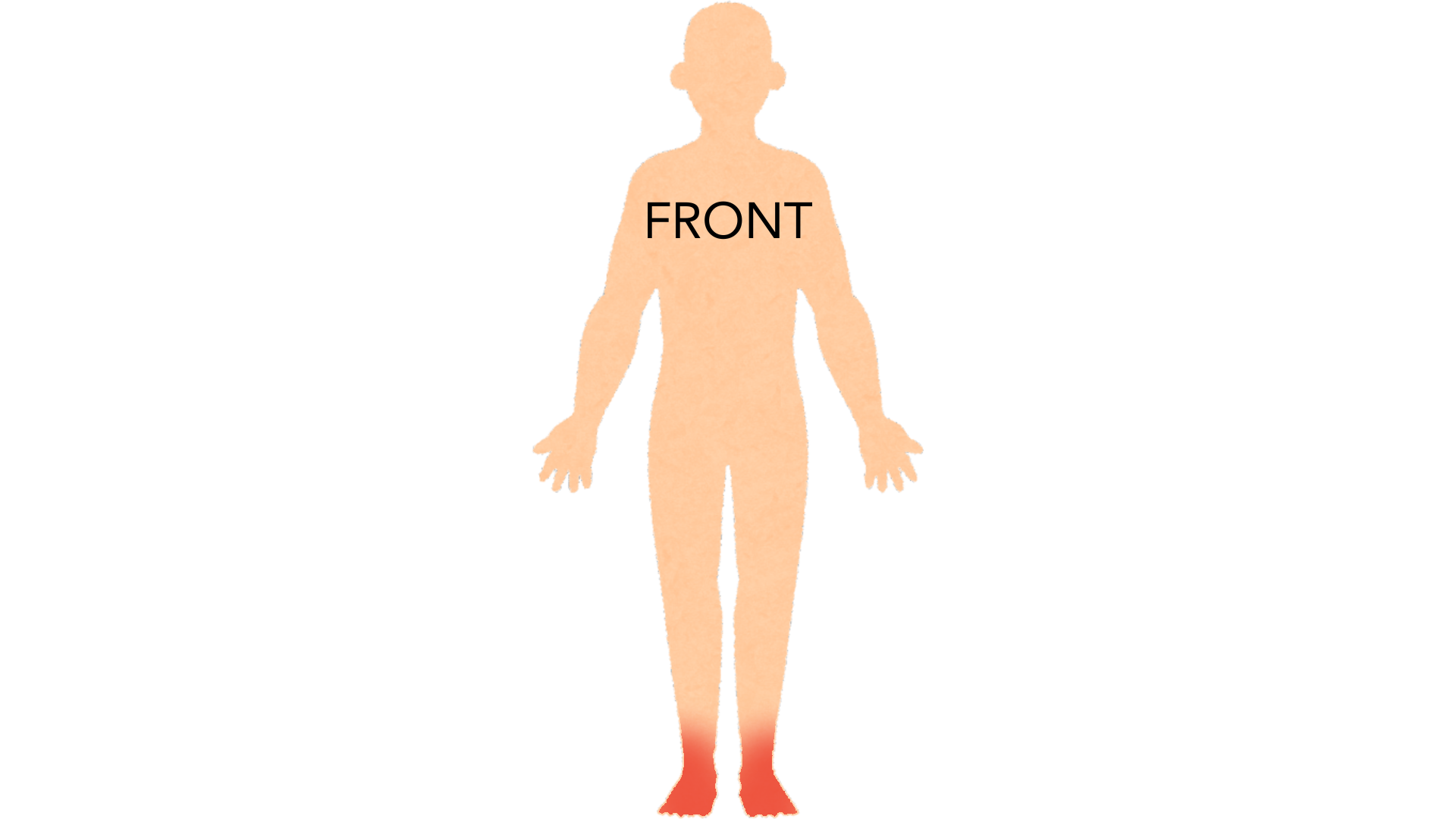 Front view of a whole body with red marks on both feet and both ankles. The rest of the body is clear.