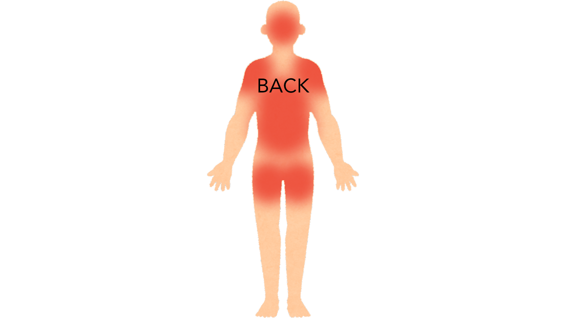 Back view of a whole body with red marks across the upper and middle back, both shoulders, the back of the head and both buttocks.