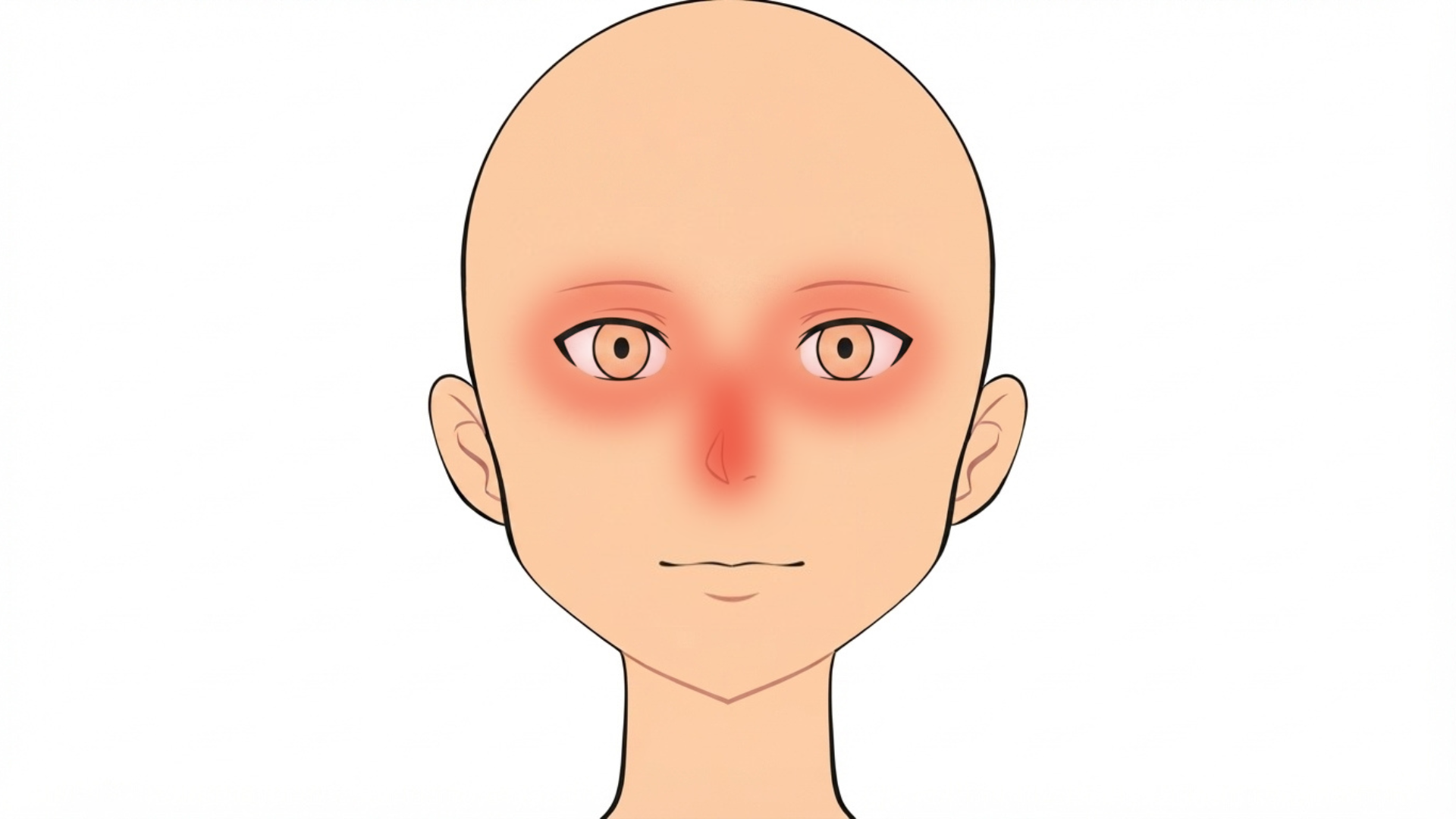 Front view of a head with red marks around both eyes, under both eyes and in the creases beside the nose.