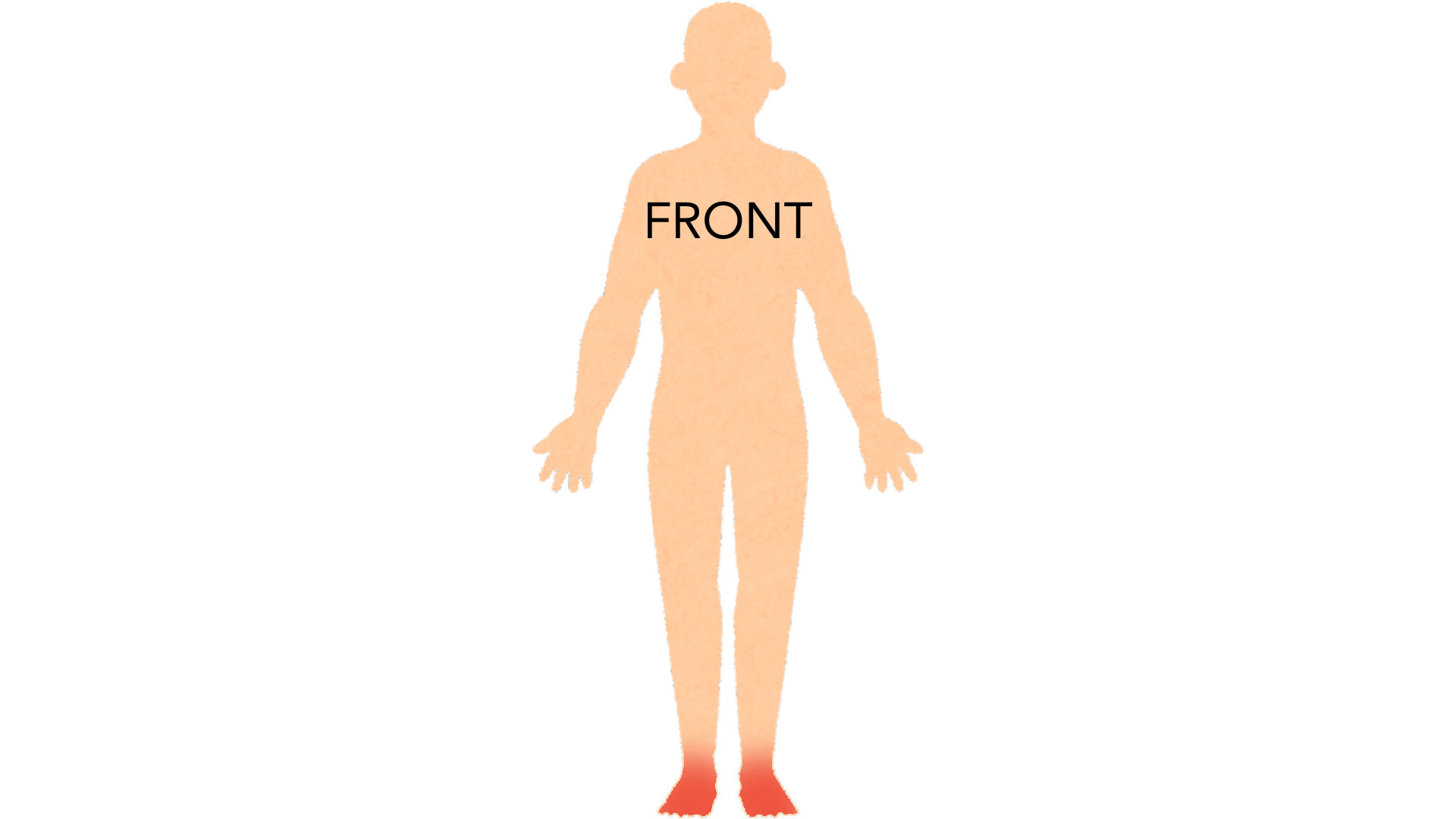 Front view of a whole body with red marks on the soles of both feet. The rest of the body is clear.