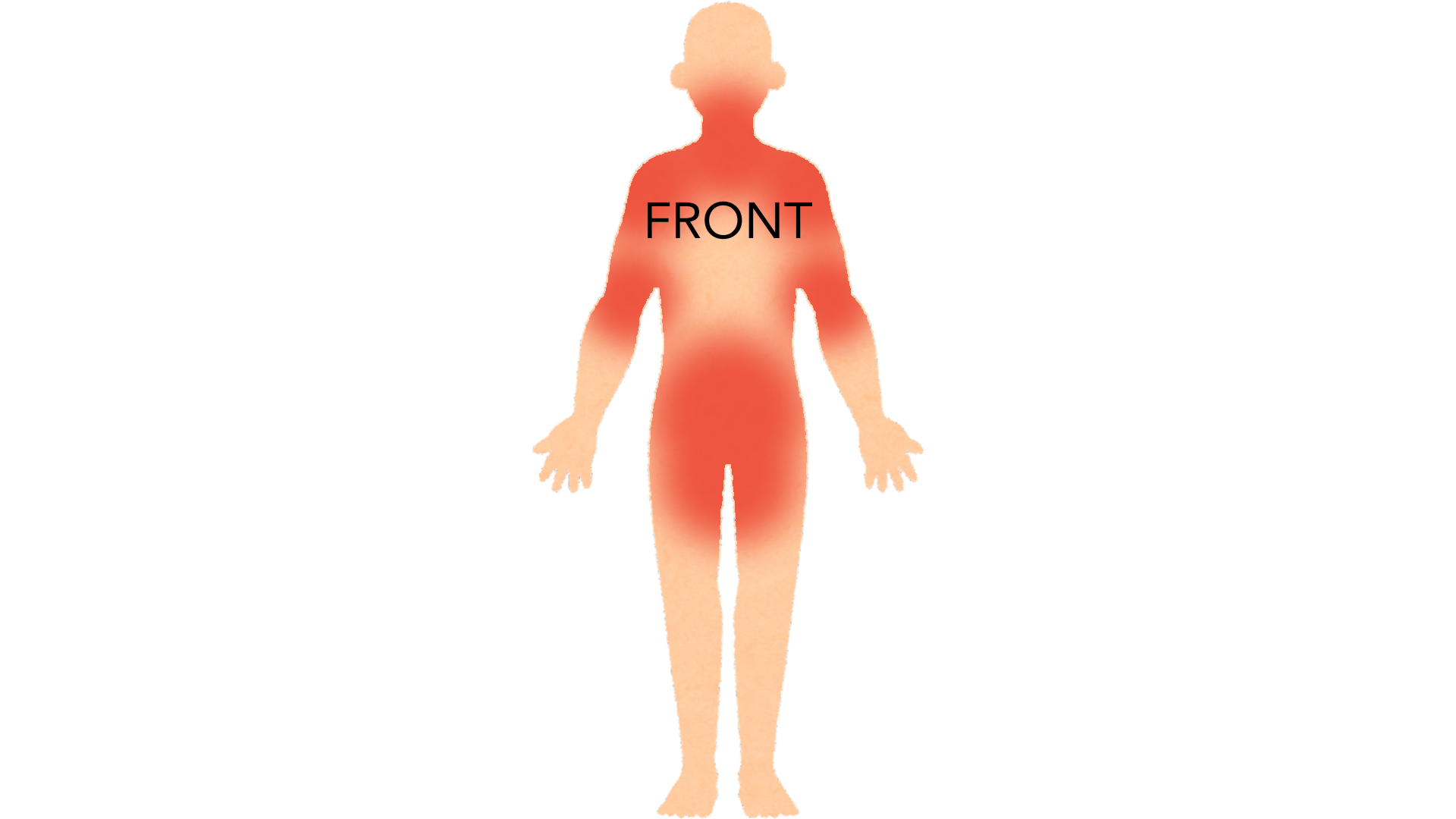 Front view of a whole body with red marks around the waistline, in both armpits, across the groin and over the neck and both shoulders.