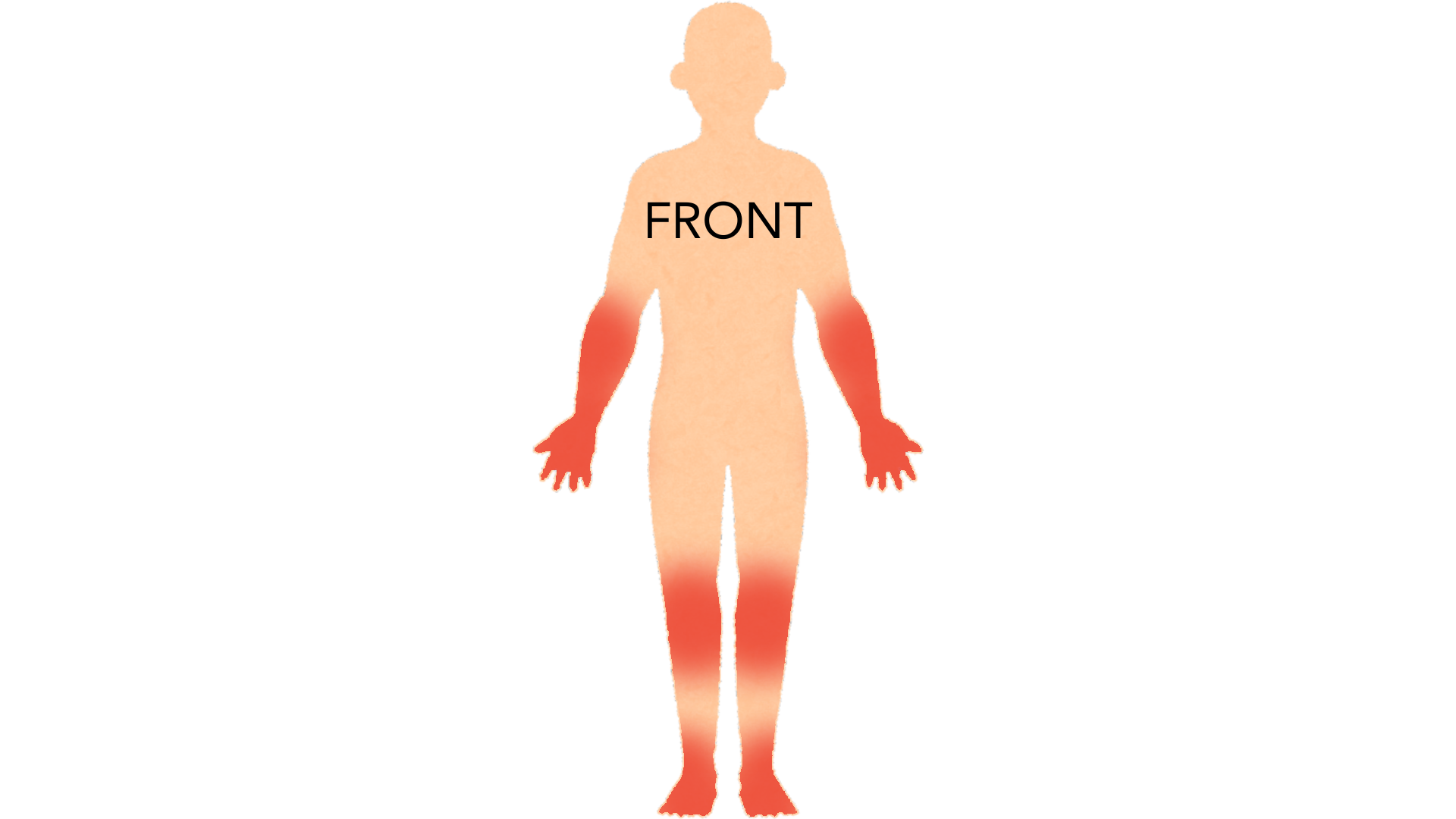 Front view of a whole body with red marks on both hands and fingers, both wrists, both elbows, both knees, both ankles and both feet.