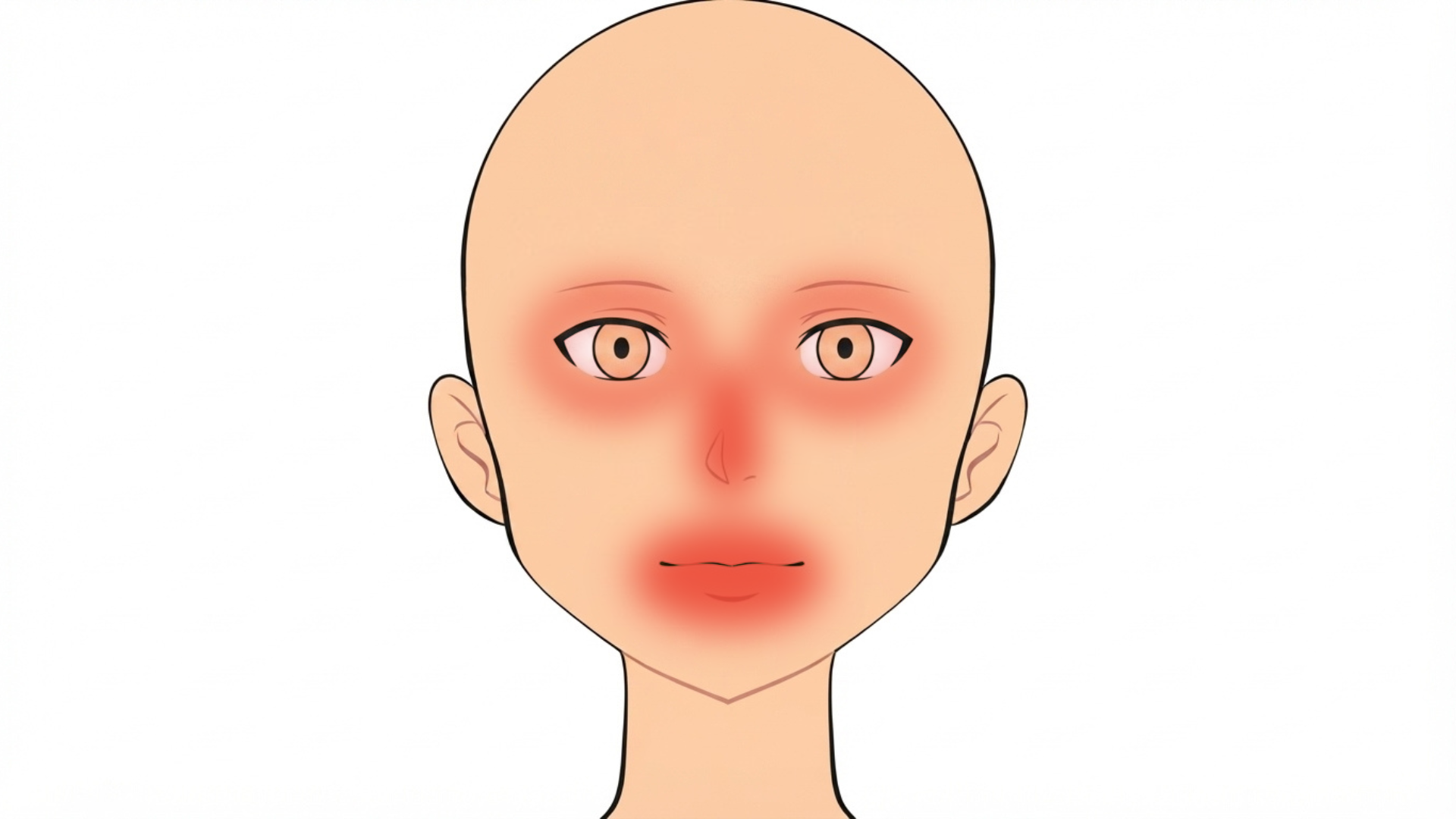 Front view of a head with red marks around both eyes, under both eyes, around the mouth and in the creases beside the nose.