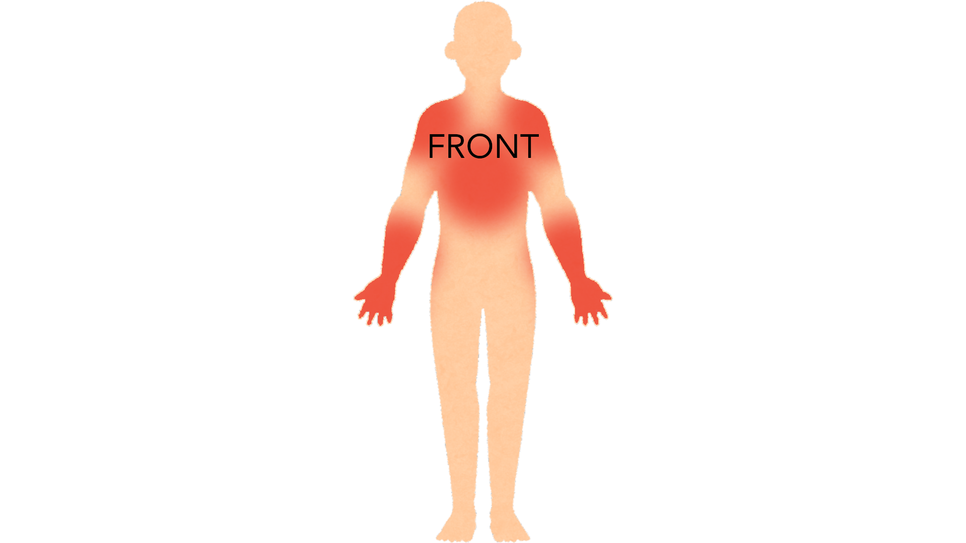 Front view of a whole body with red marks on the backs of both hands, on both forearms, across the upper chest and over both shoulders.