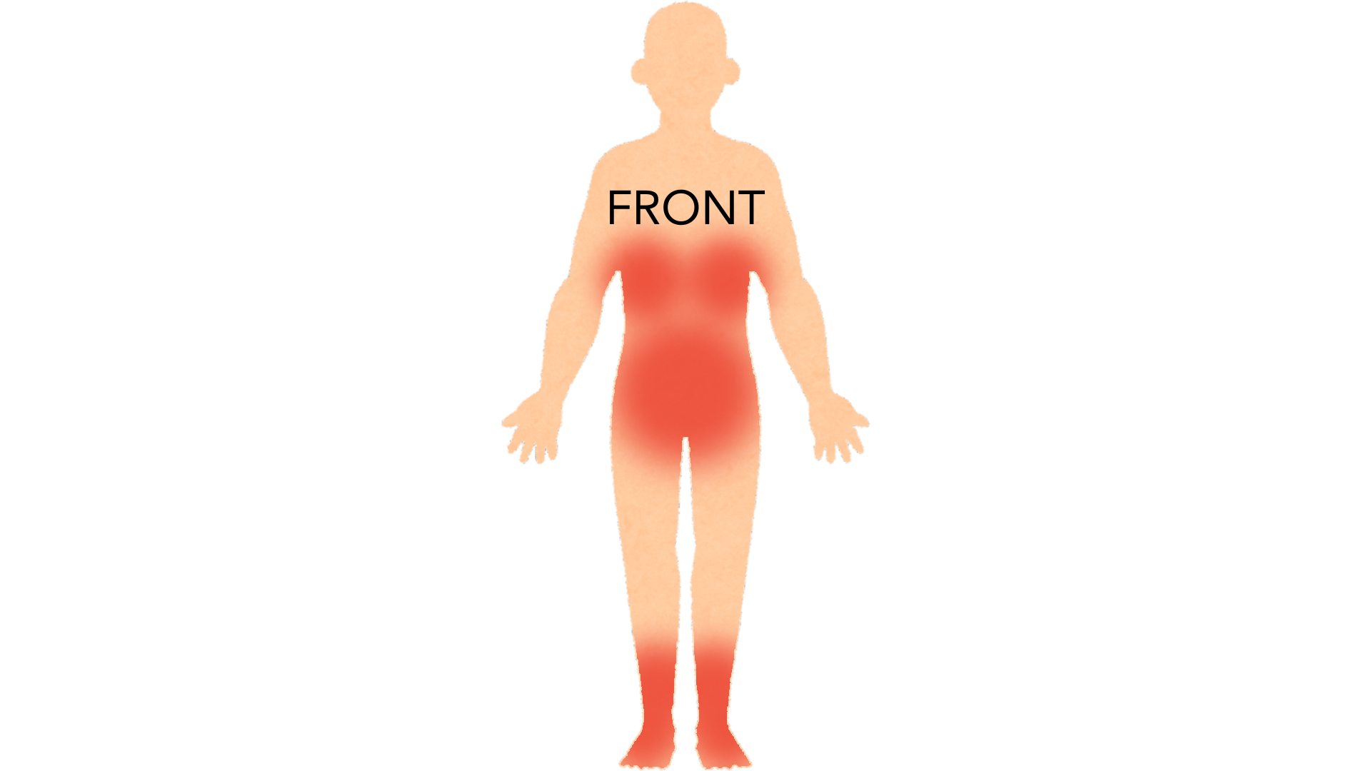 Front view of a whole body with red marks under both breasts, around the waistline and down both shins and ankles.