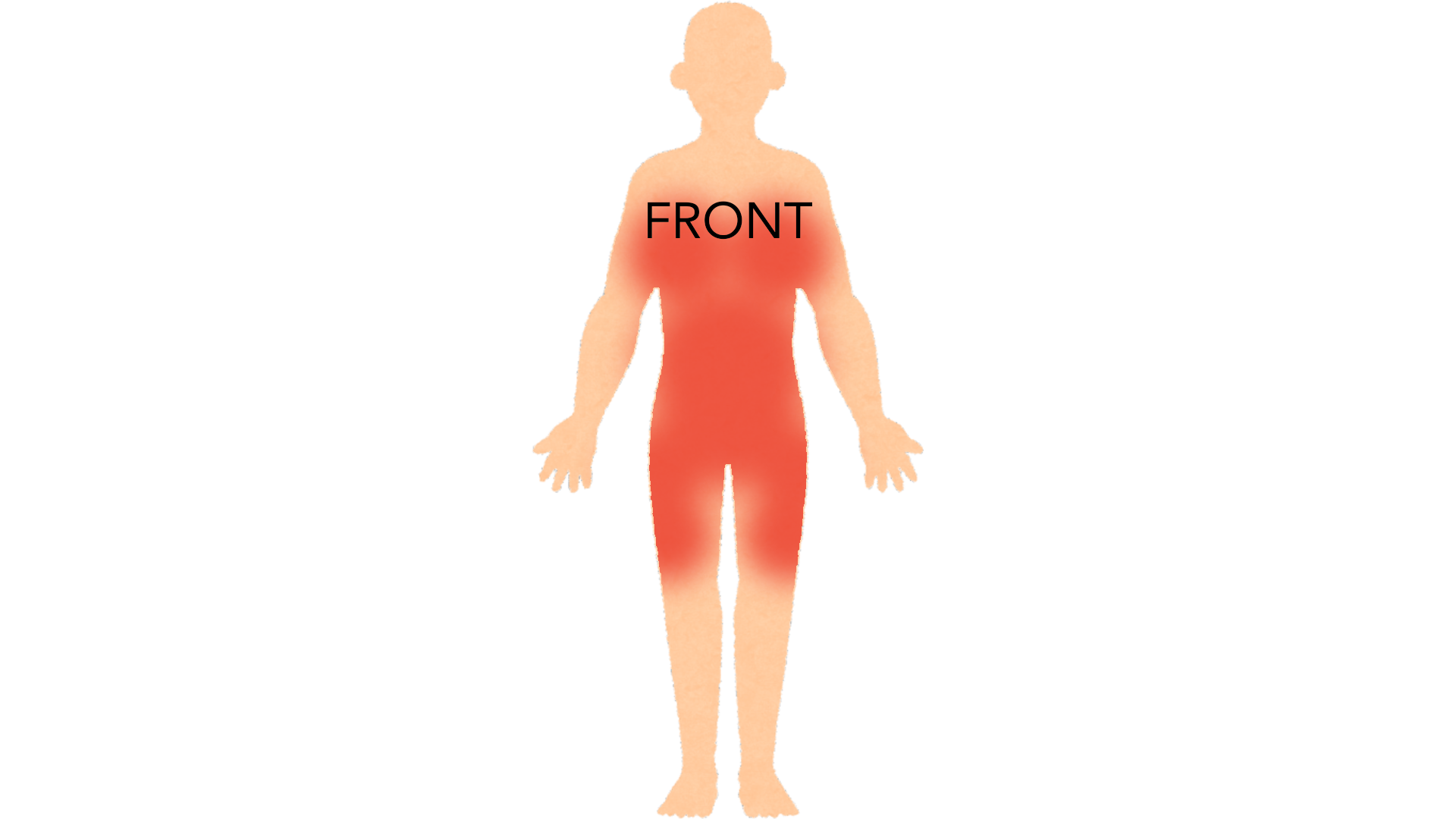 Front view of a whole body with red marks across the abdomen and waist, on both breasts, over both hips and down the outer surface of both thighs.