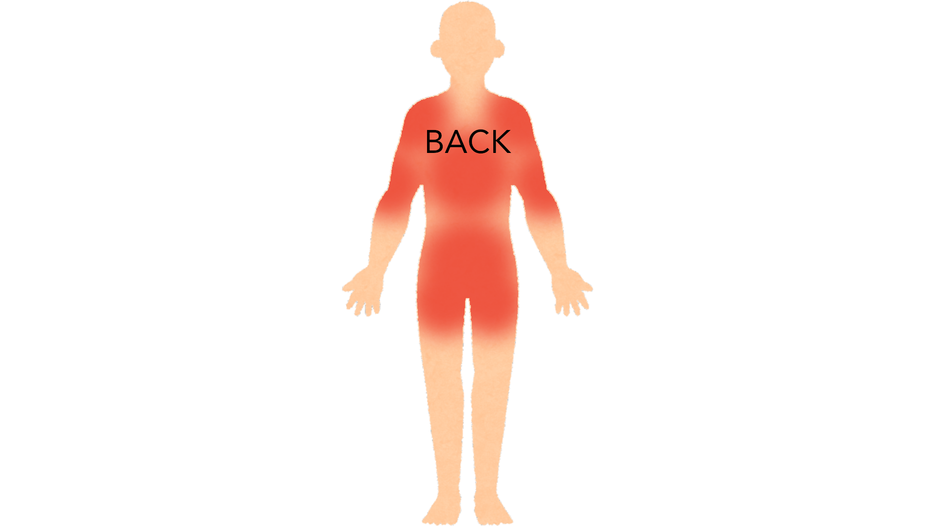Back view of a whole body with red marks on both buttocks, across the lower back, over both shoulders and the upper back and down both upper arms.