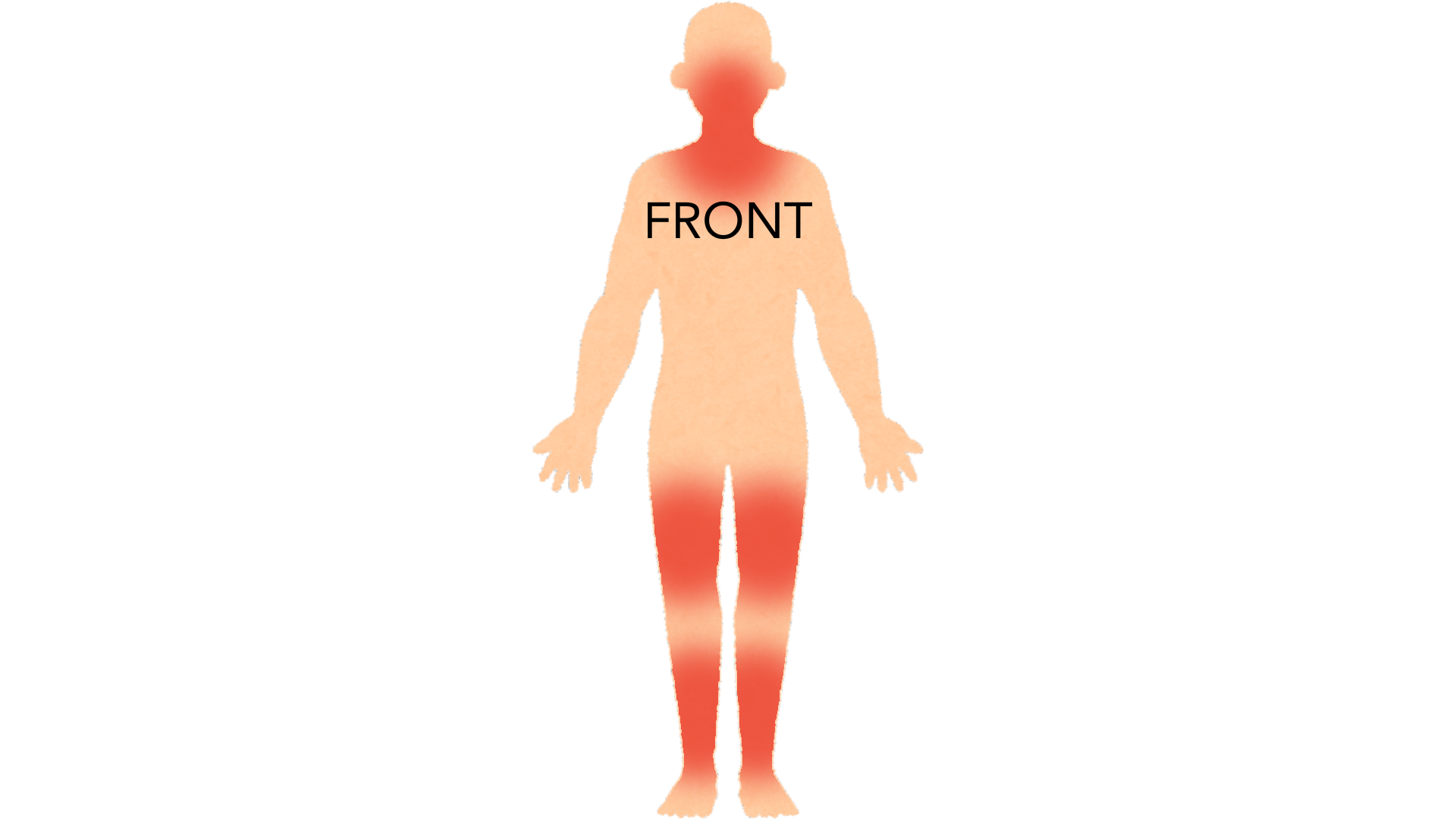 Front view of a whole body with red marks down both lower legs and thighs and on the face and neck.