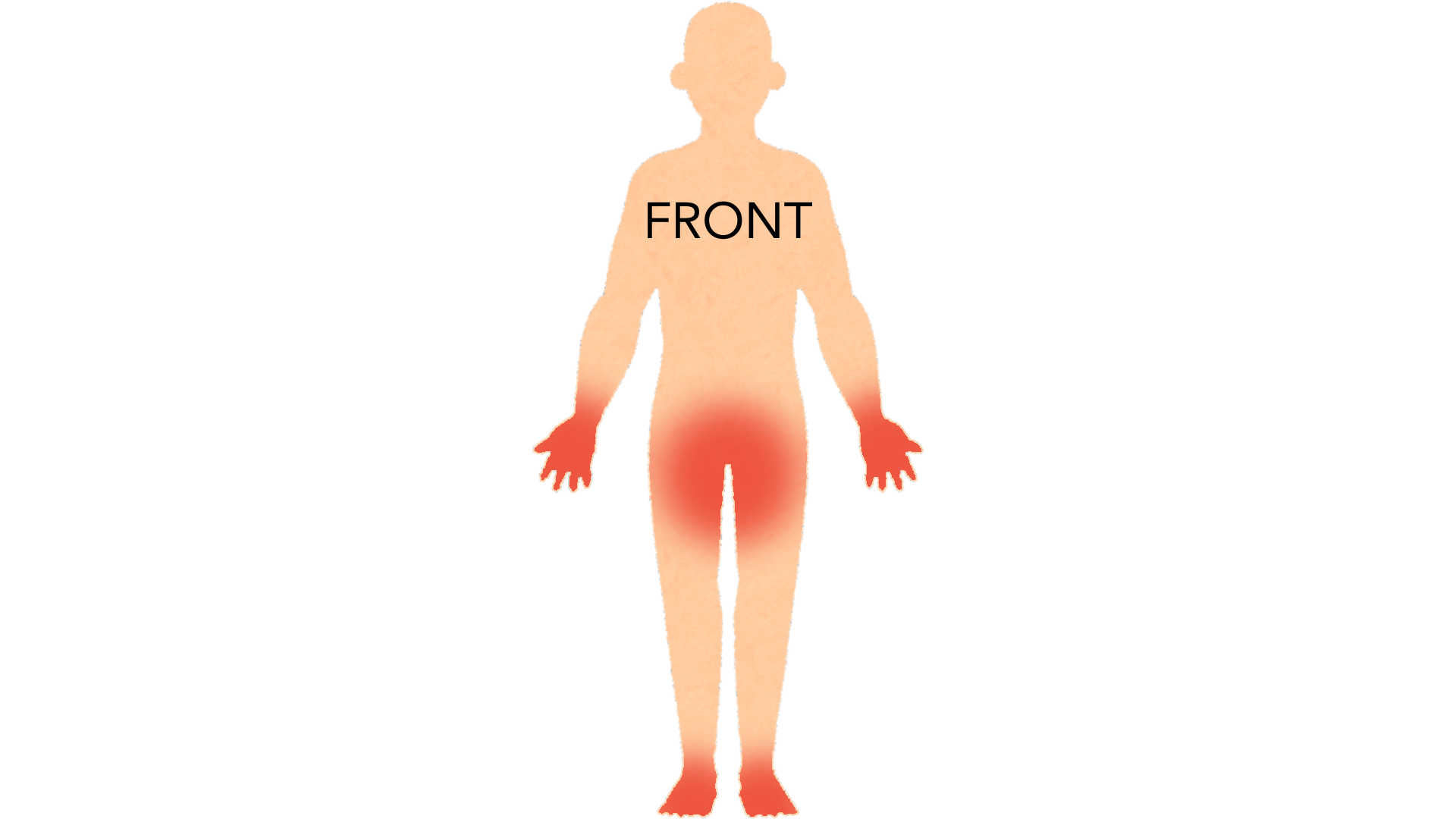 Front view of a whole body with red marks on both palms and fingers, on both soles and across the genital area.