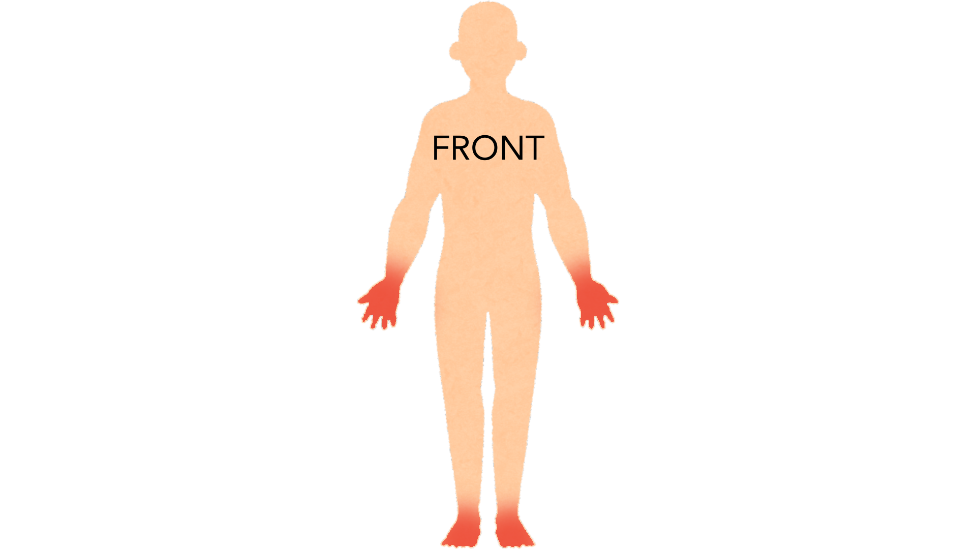 Front view of a whole body with red marks on both hands and fingers and on both feet. The rest of the body is clear.
