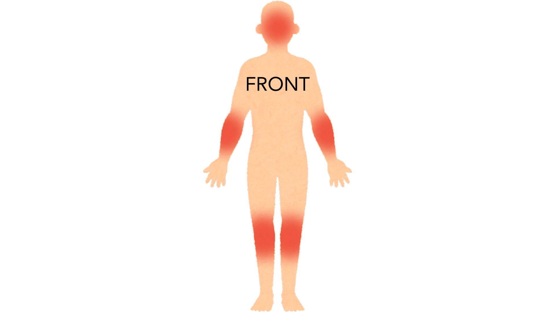 Front view of a whole body with red marks on both elbows, both knees and the scalp. The rest of the body is clear.