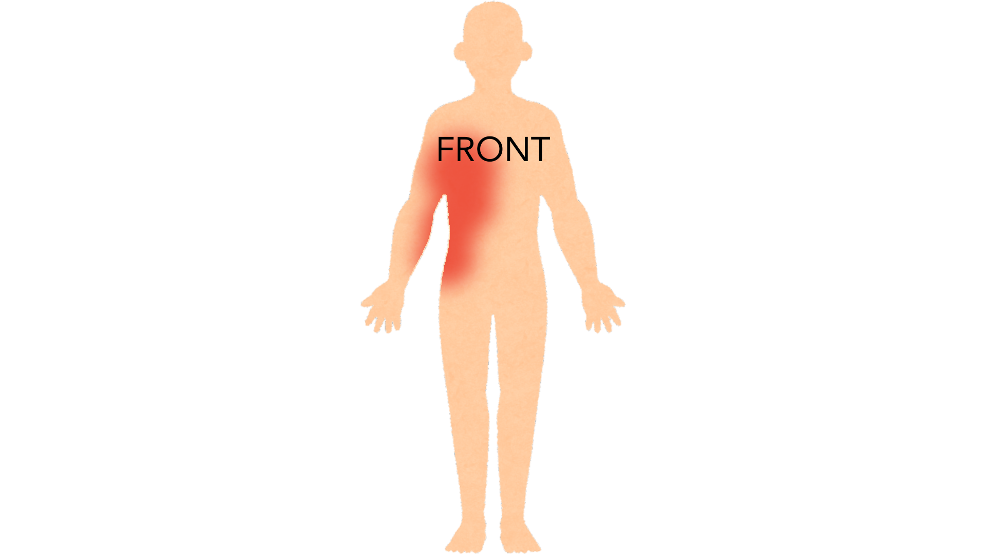 Front view of a whole body with red marks forming a band down one side of the chest and waist, stopping at the middle of the body. The other side is clear.