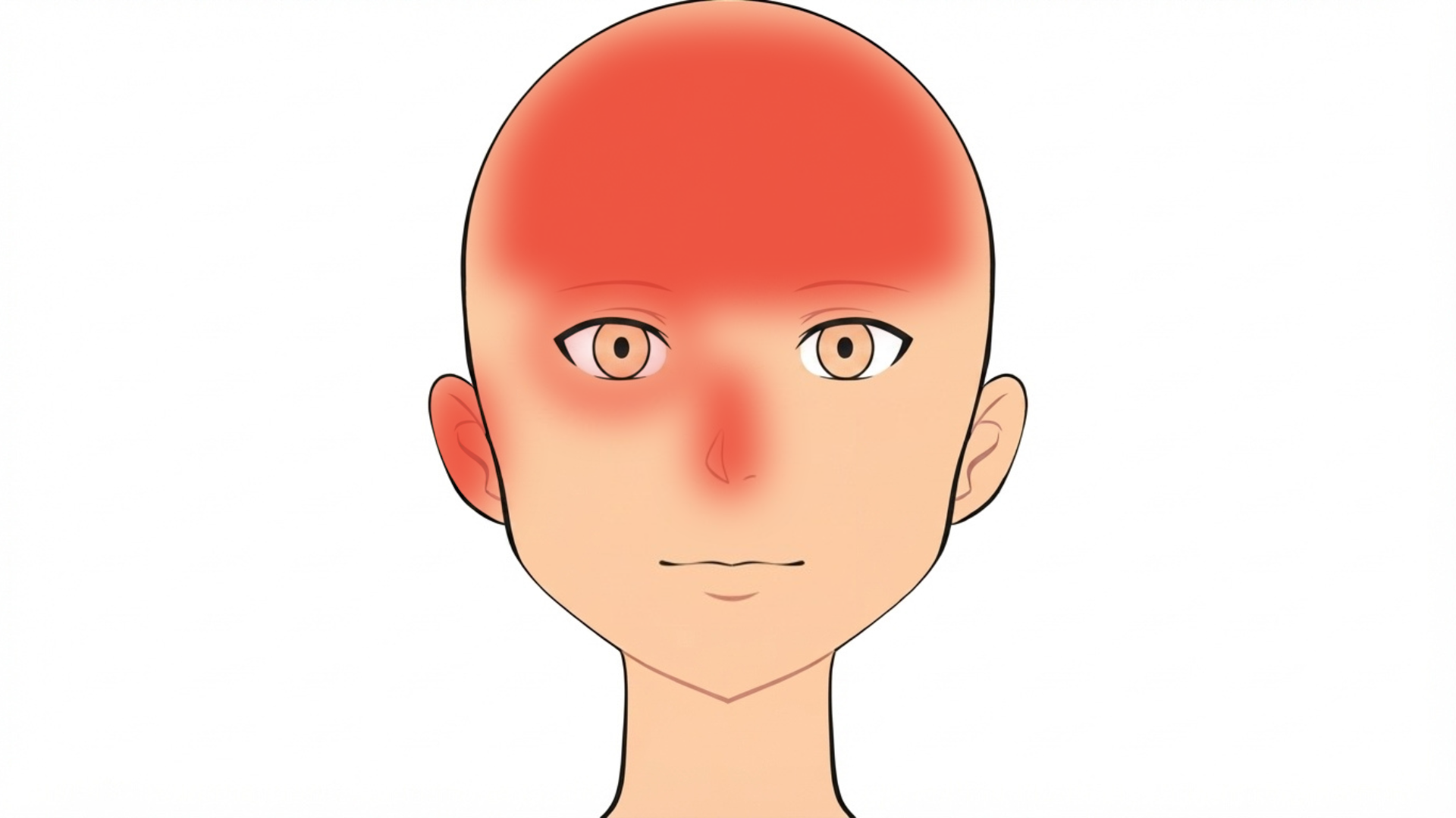 Front view of a head with red marks down one side of the scalp and forehead, over one eyebrow and eye, and on the tip of the nose. The other side is clear.