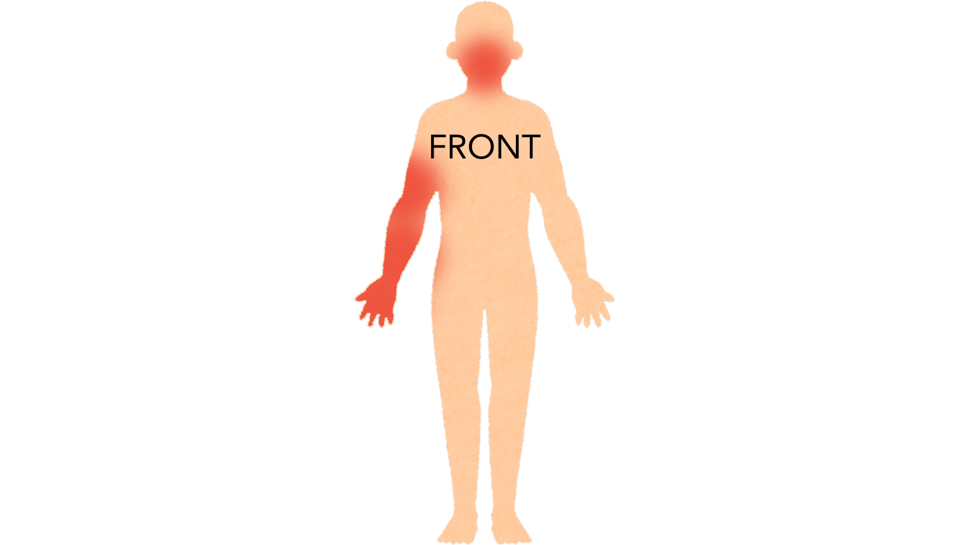 Front view of a whole body with red marks down one arm from the upper arm to the hand, and on one side of the face around the eye and cheek. The rest of the body is clear.