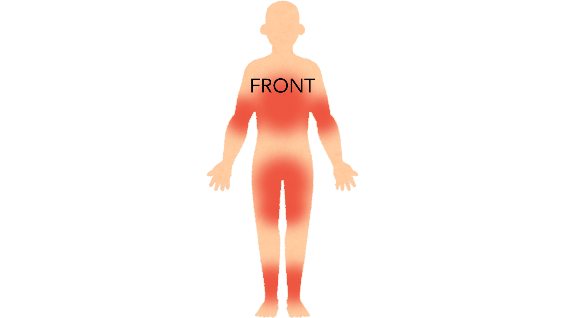 Front view of a whole body with red marks across the groin and bikini line, in both armpits, on the chest and down both lower legs.