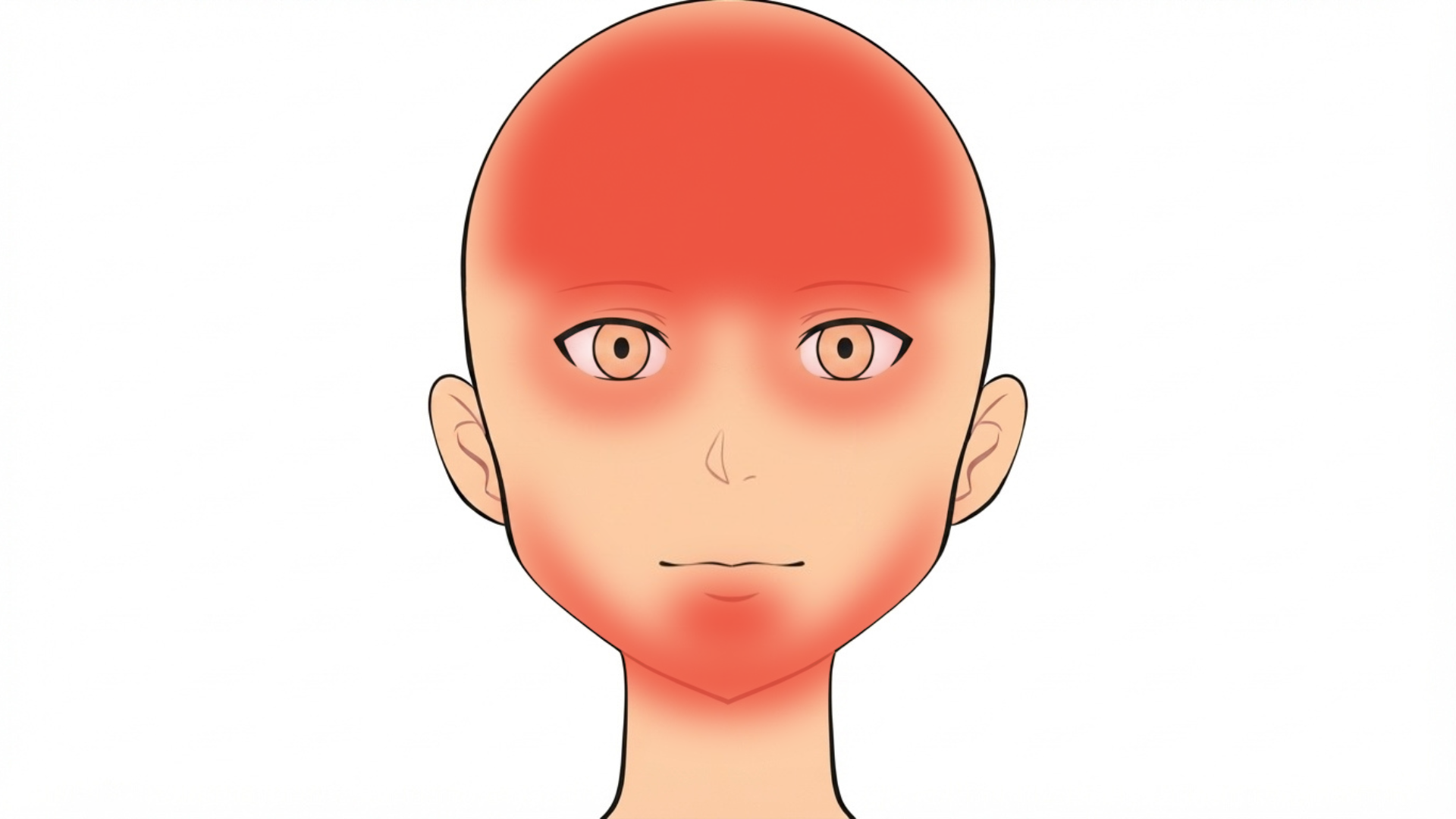 Front view of a head with red marks across the scalp, on both eyebrows, around both eyes and along the beard area of the jaw and chin.