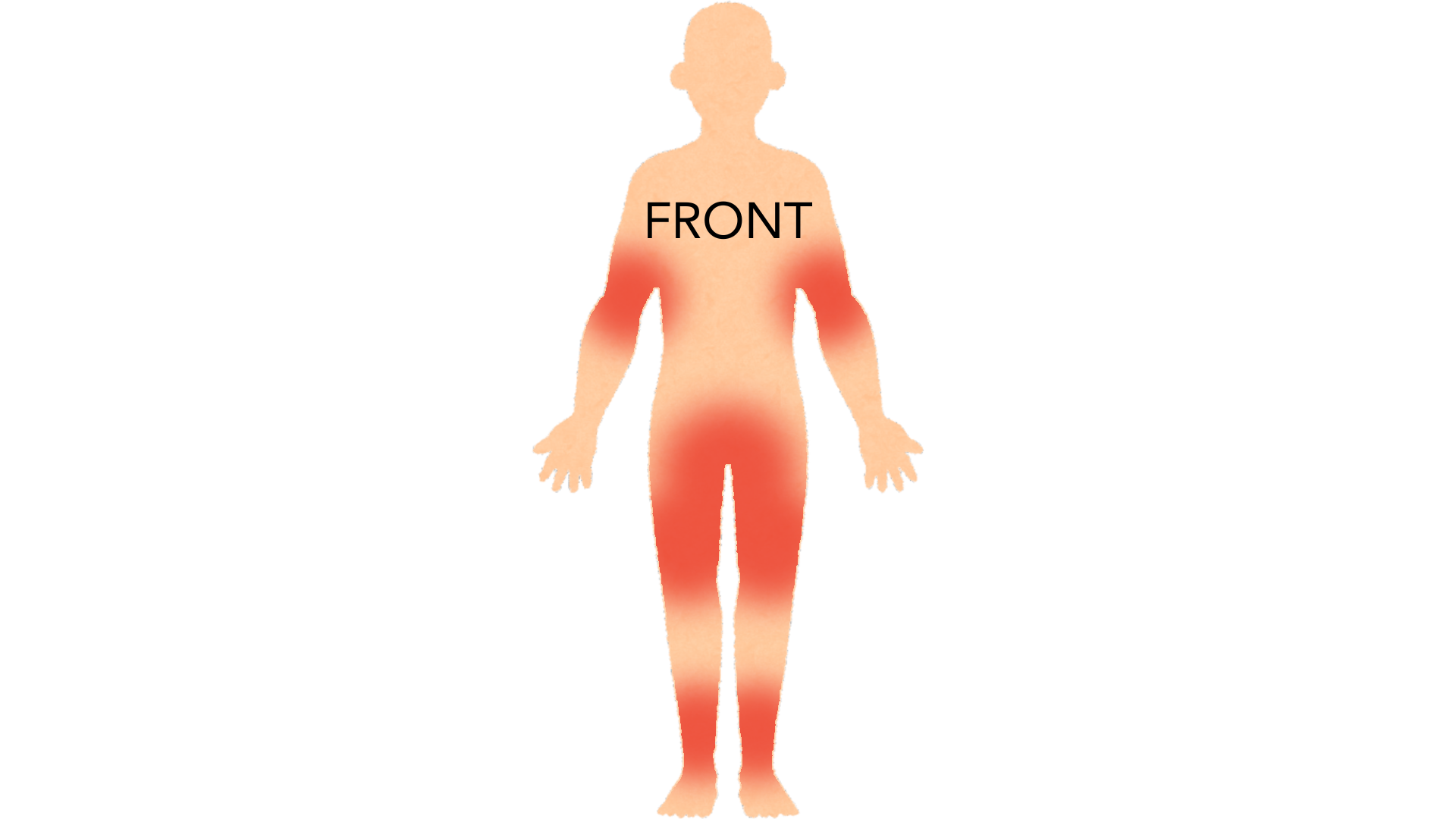Front view of a whole body with red marks in both armpits, across the groin and bikini line and down both thighs and shins.
