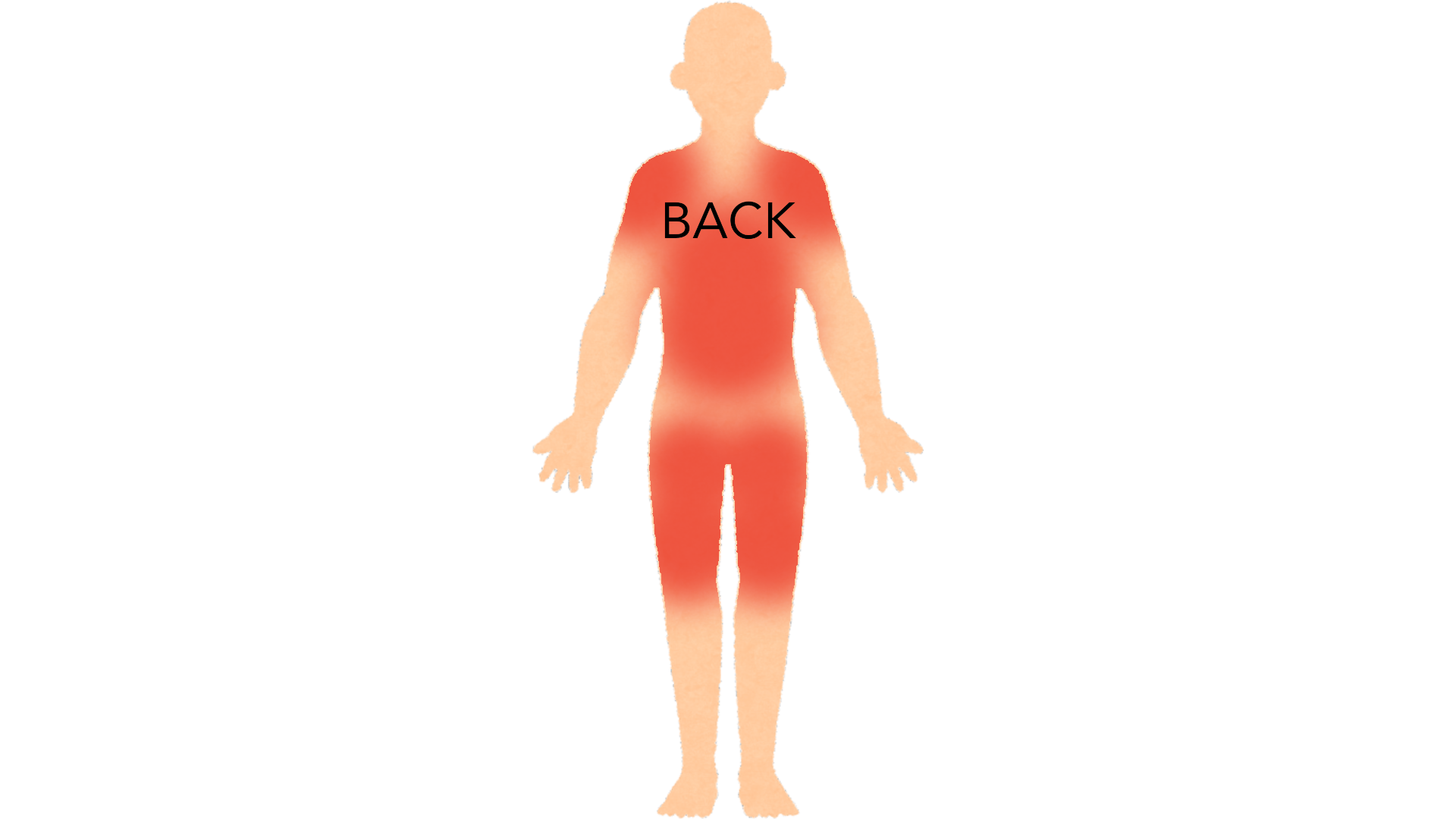 Back view of a whole body with red marks across the upper back and shoulders, on both buttocks and down both thighs.