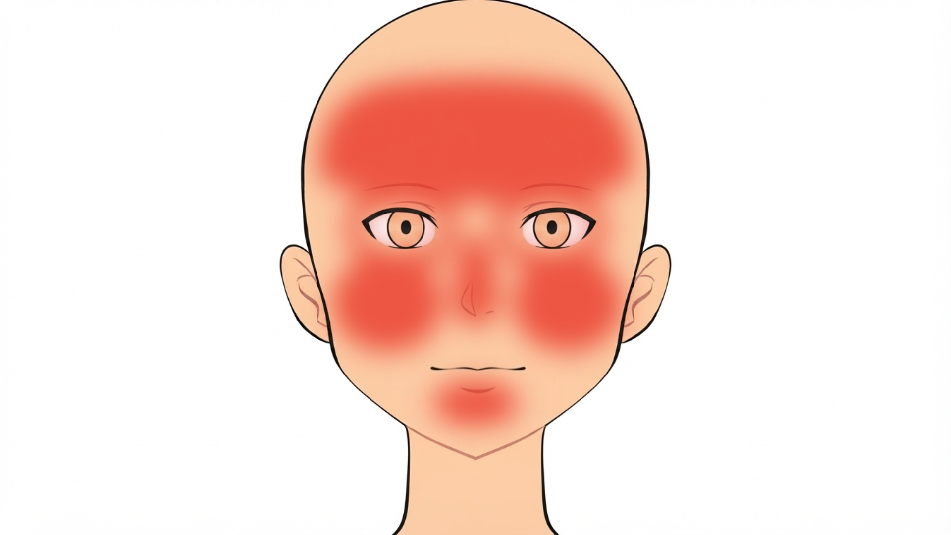 Front view of a head with red marks on both eyelids, under both eyes, on both upper cheeks, on the nose, on the forehead and on the chin.