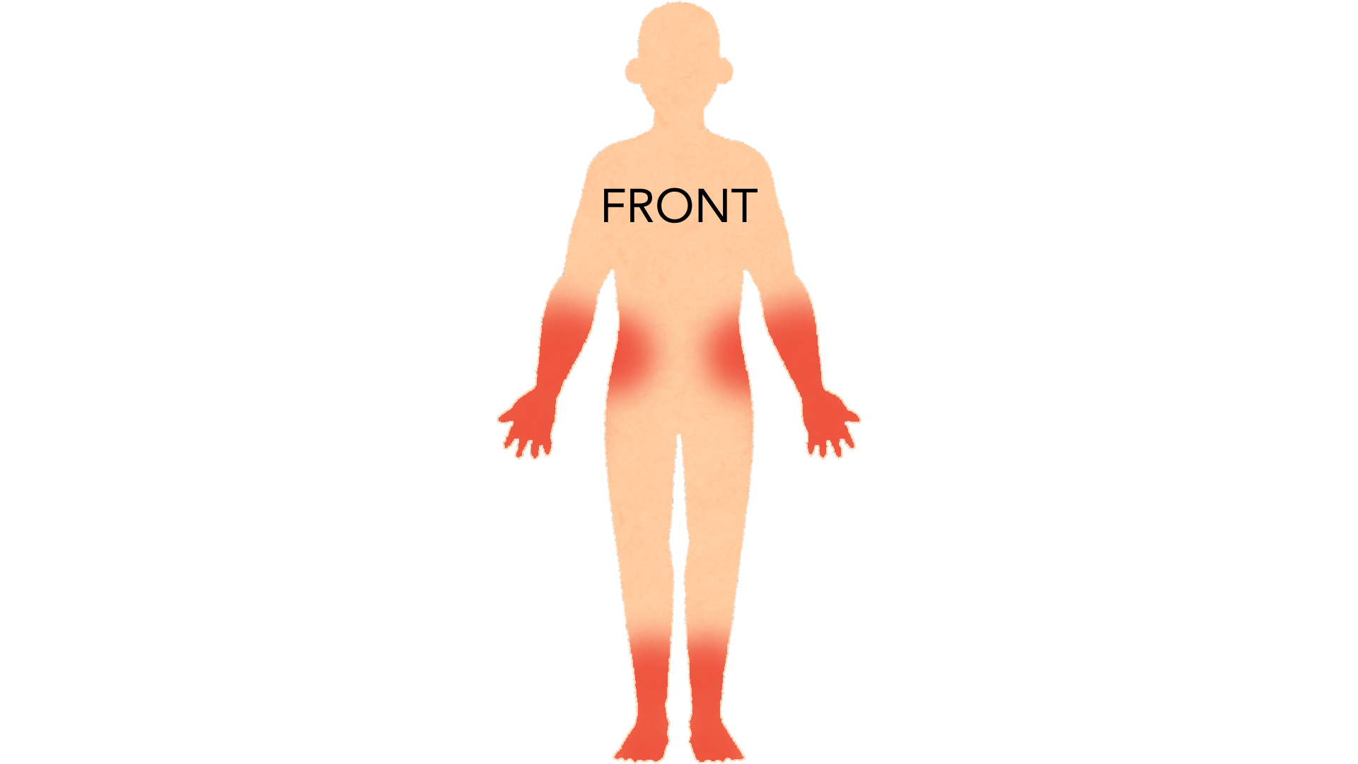 Front view of a whole body with red marks on both shins, both forearms, the backs of both hands, both sides of the trunk and both feet.