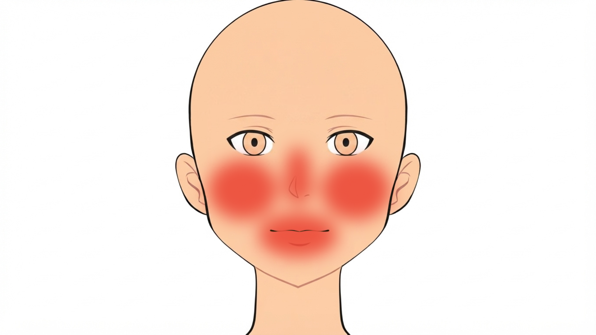 Front view of a head with red marks on both cheeks, on the upper and lower lip and in the creases beside the nose.