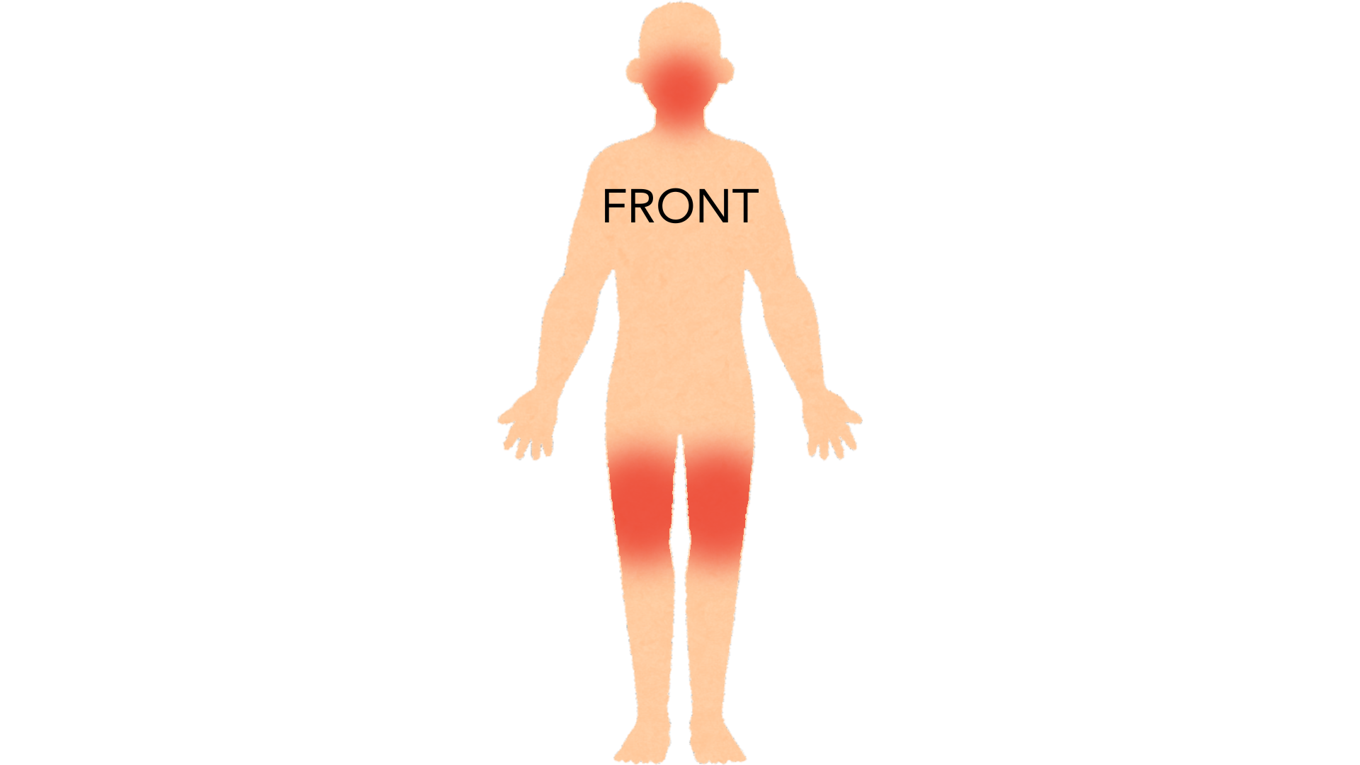 Front view of a whole body with red marks on the fronts of both thighs and on both cheeks of the face.