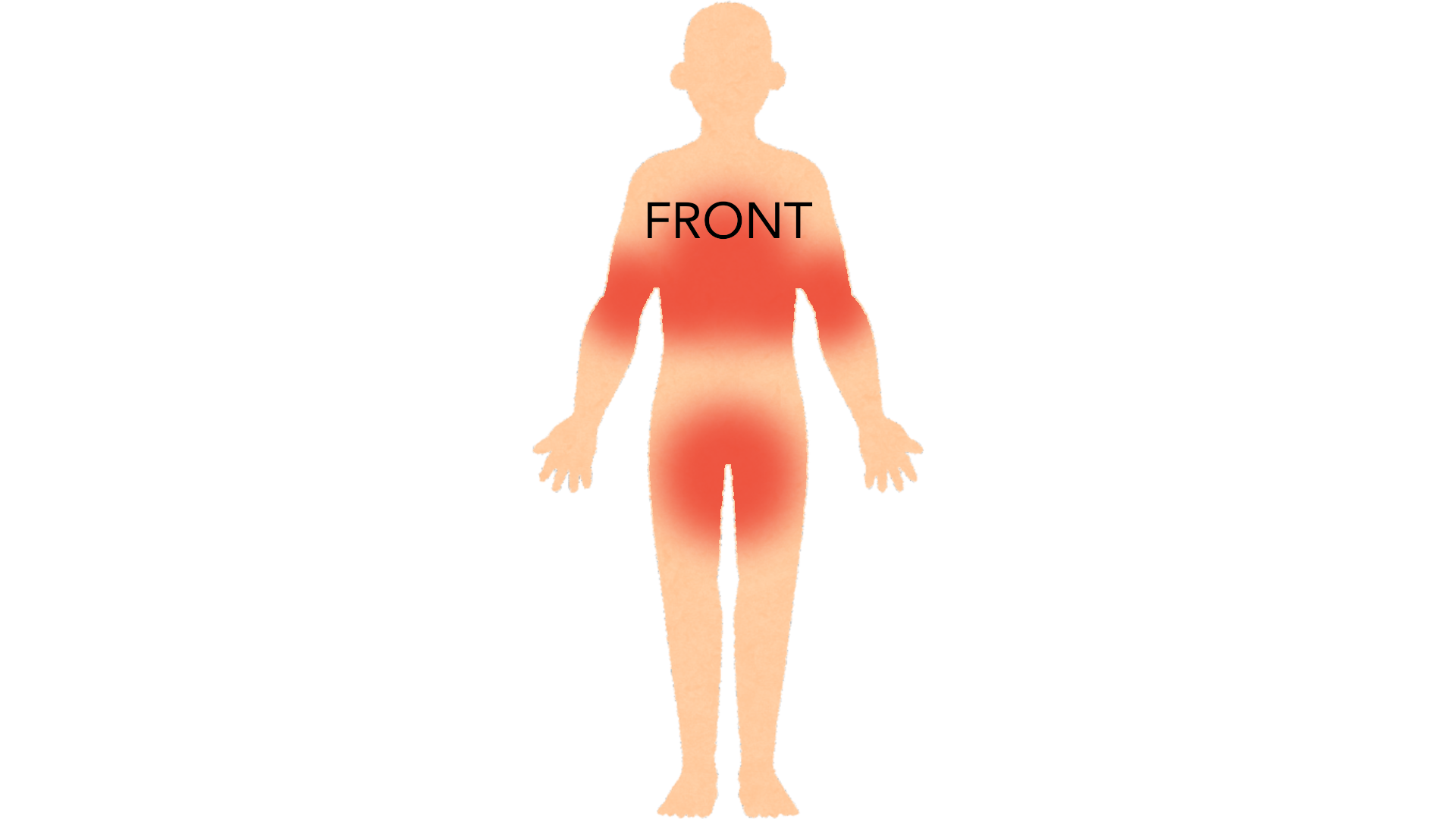 Front view of a whole body with red marks down the middle of the chest, in both armpits, under both breasts and across the groin.