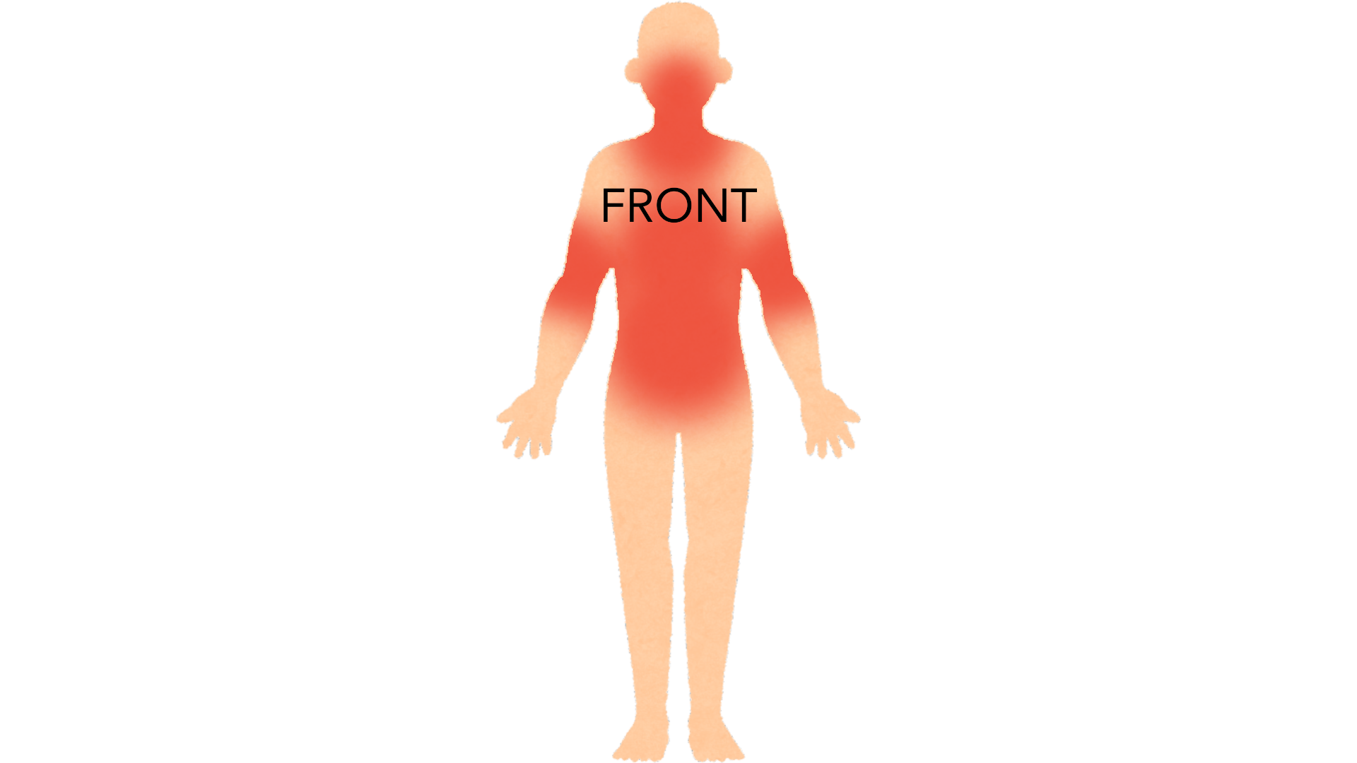 Front view of a whole body with red marks in both armpits, on the neck and face, across the chest and abdomen and on the inner surfaces of both arms.
