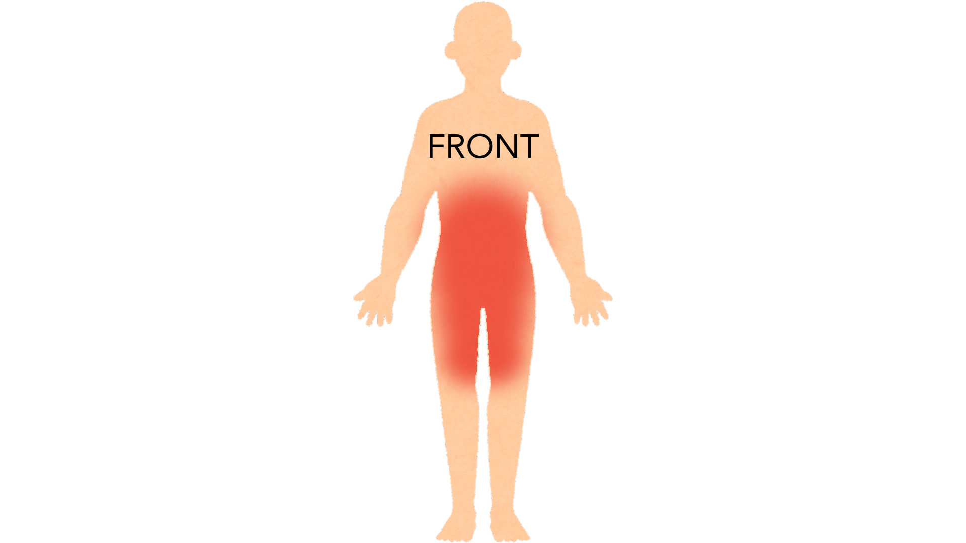 Front view of a whole body with red marks across the lower abdomen and waist, the groin and both inner thighs. The rest of the body is clear.
