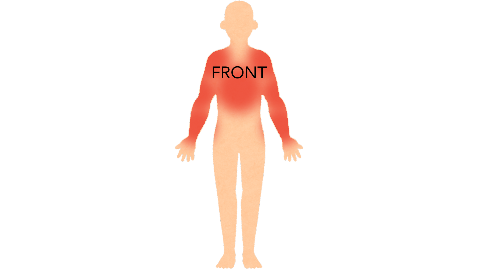 Front view of a whole body with red marks across the upper chest, both shoulders, both upper arms and both forearms. The rest of the body is clear.