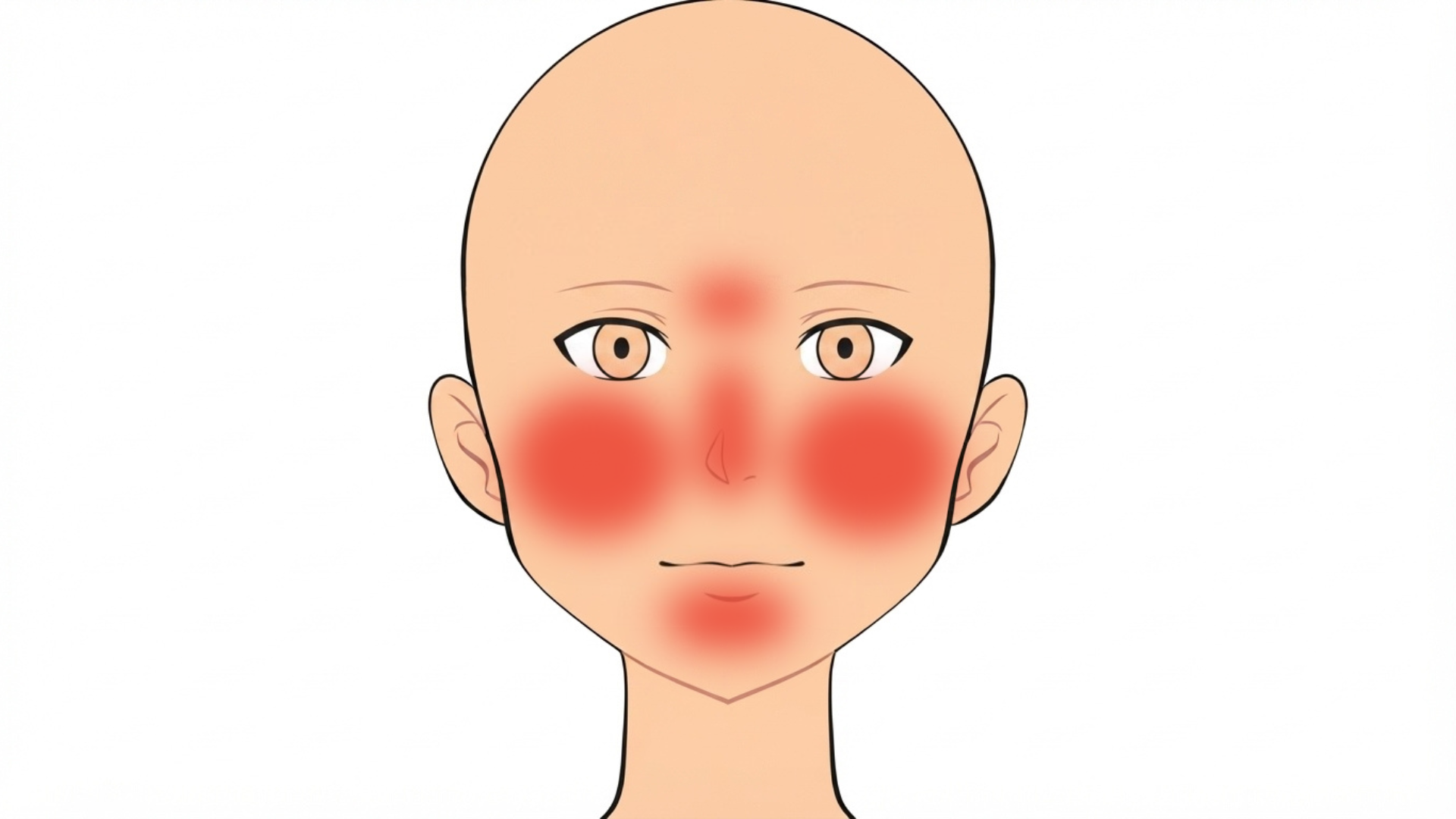 Front view of a head with red marks across both upper cheeks, the nose, the chin and the skin between the brows. The sides of the face are clear.