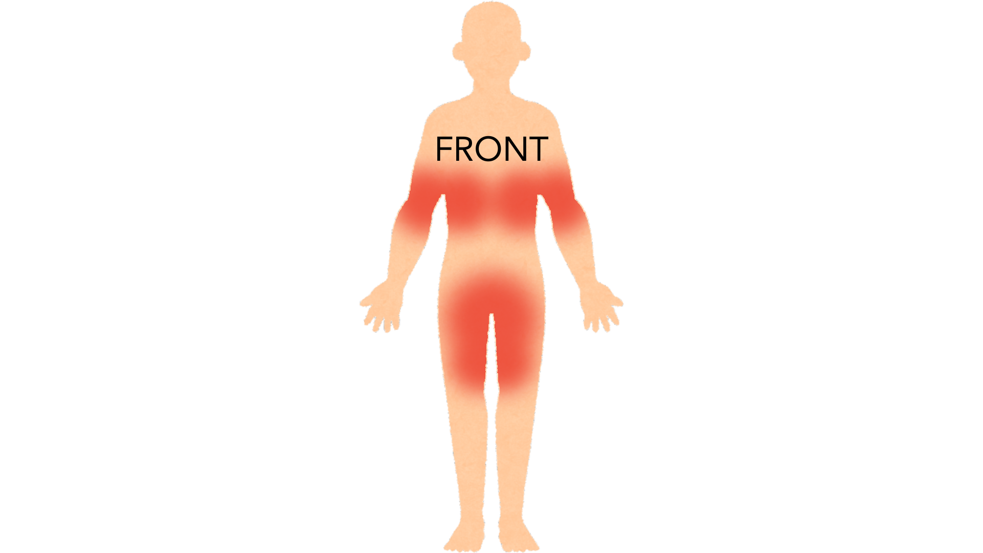 Front view of a whole body with red marks in both armpits, under both breasts, across the groin and on both inner thighs.