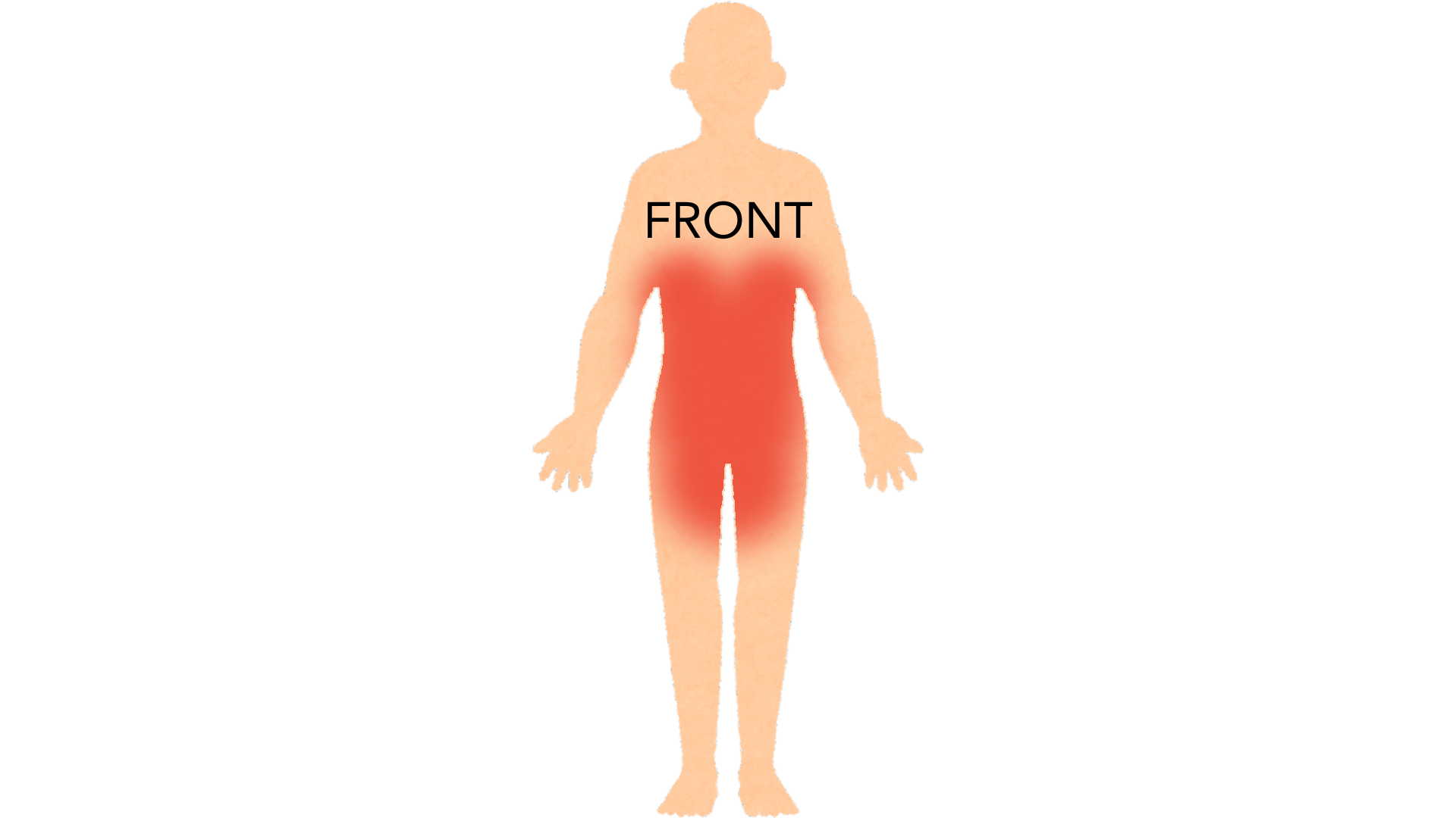 Front view of a whole body with red marks around the waistline and belt area, under both breasts, across the lower abdomen and over the genital area.