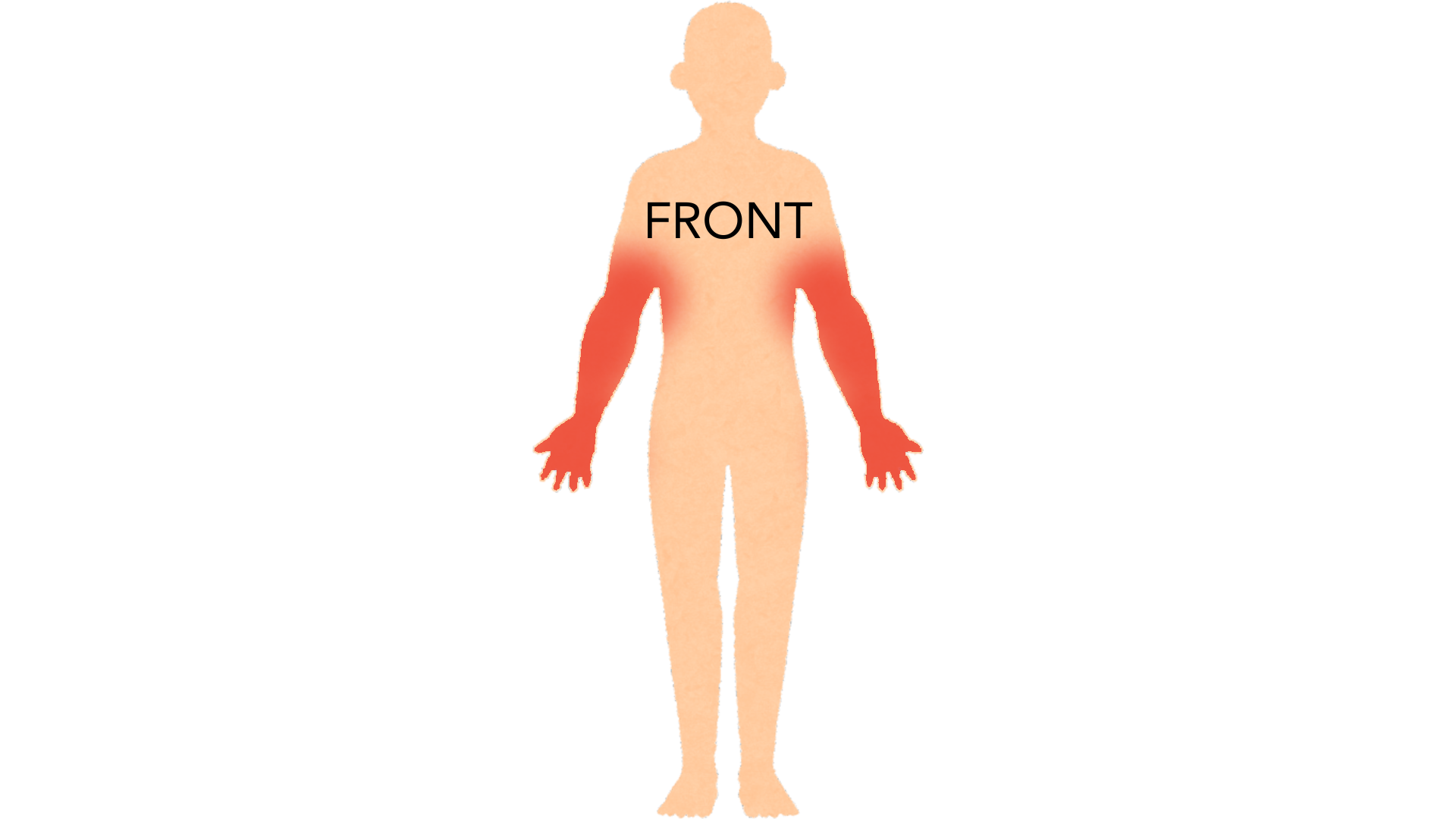 Front view of a whole body with red marks between and along both hands and fingers, on both wrists, on both elbows and in both armpits.