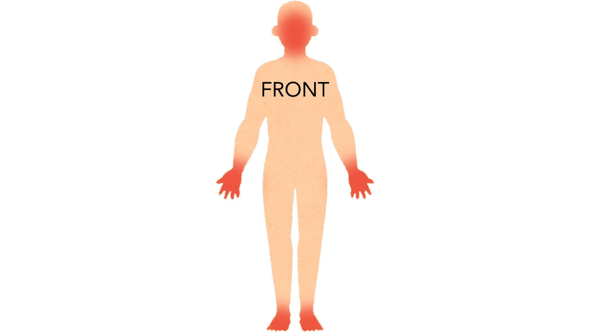 Front view of a whole body with red marks on the head and face, on both palms and on both soles. The rest of the body is clear.