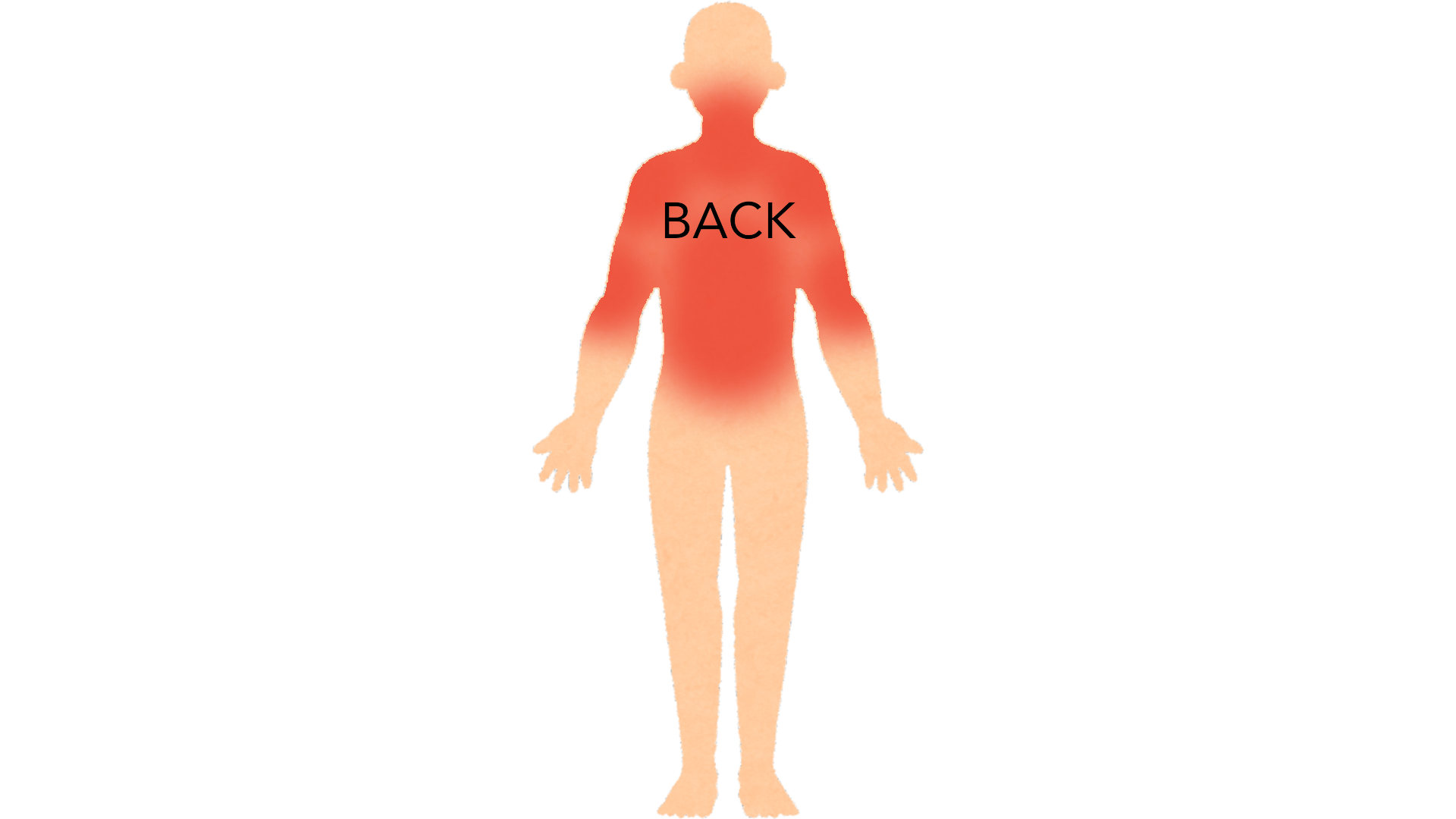 Back view of a whole body with red marks across the upper and middle back, both shoulders, both upper arms and the back of the neck.