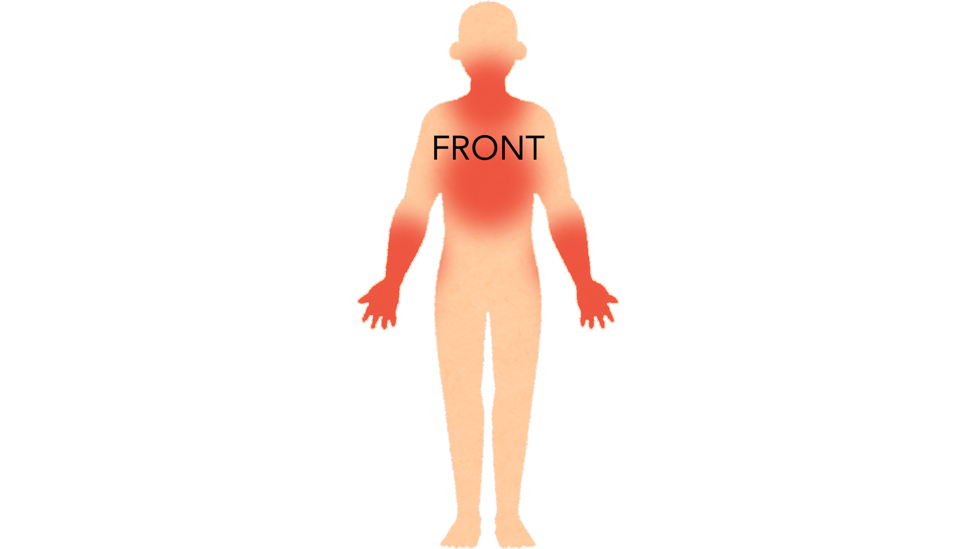 Front view of a whole body with red marks on the front of the neck, across the upper chest, on both forearms and on the backs of both hands.