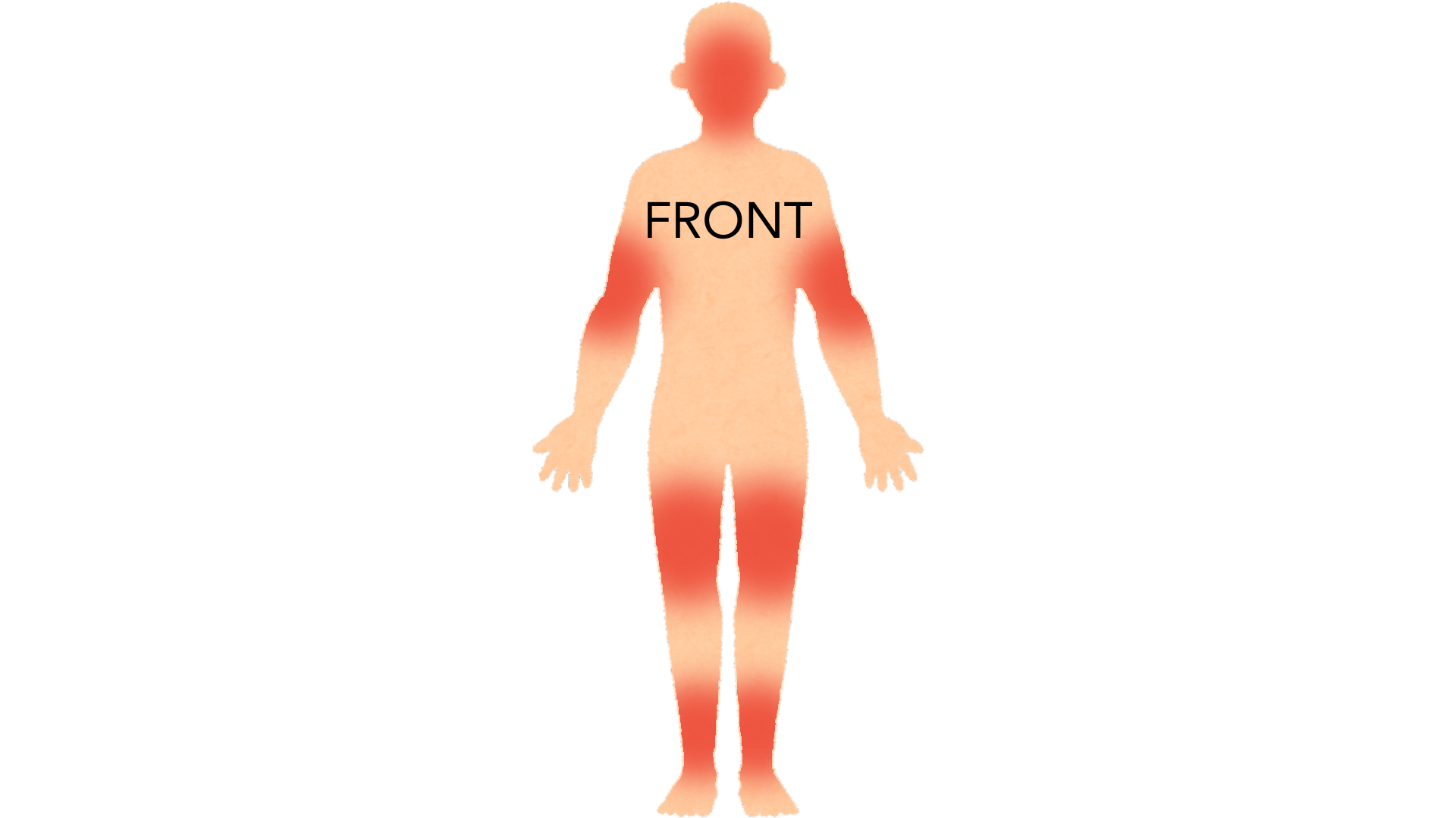 Front view of a whole body with red marks on the face and scalp, on the outer surfaces of both arms and on both legs. The nappy area is clear.
