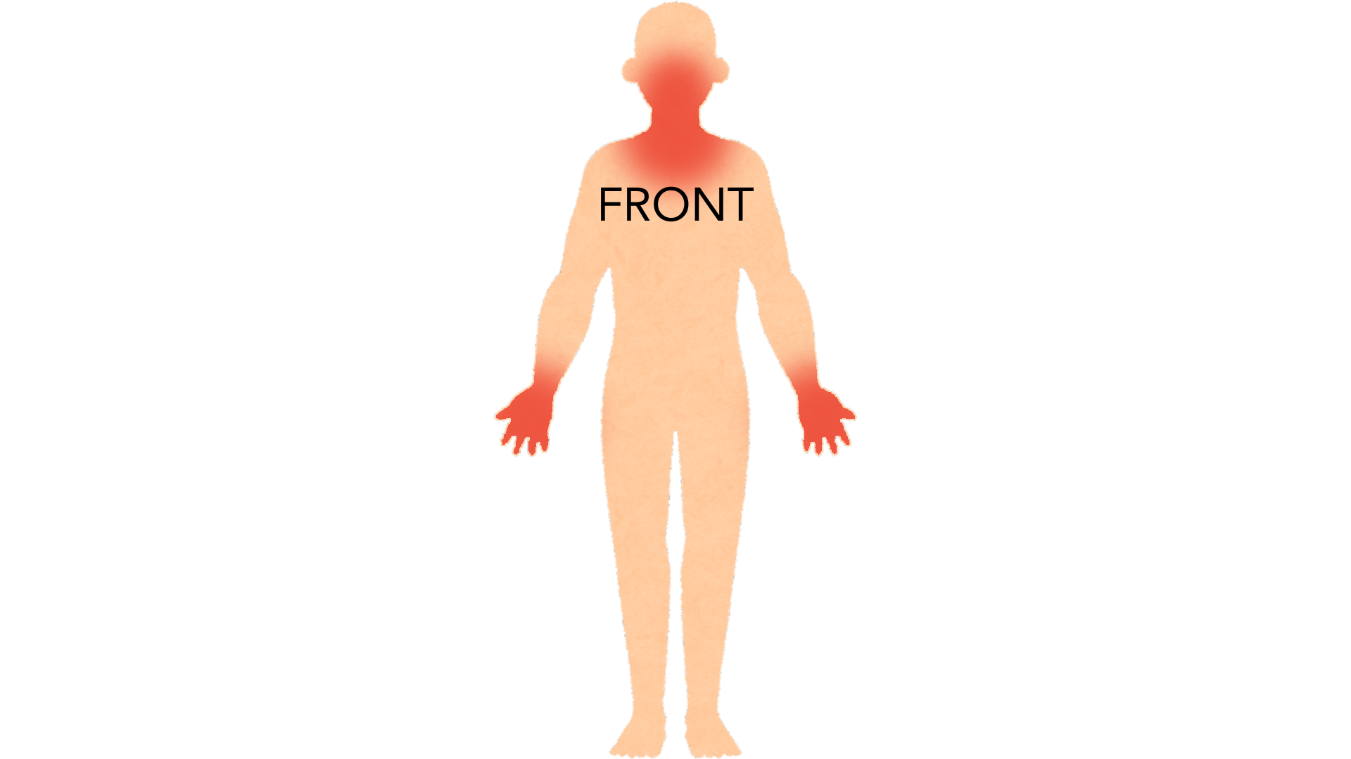 Front view of a whole body with red marks on both hands and fingers and on the face and neck. The rest of the body is clear.