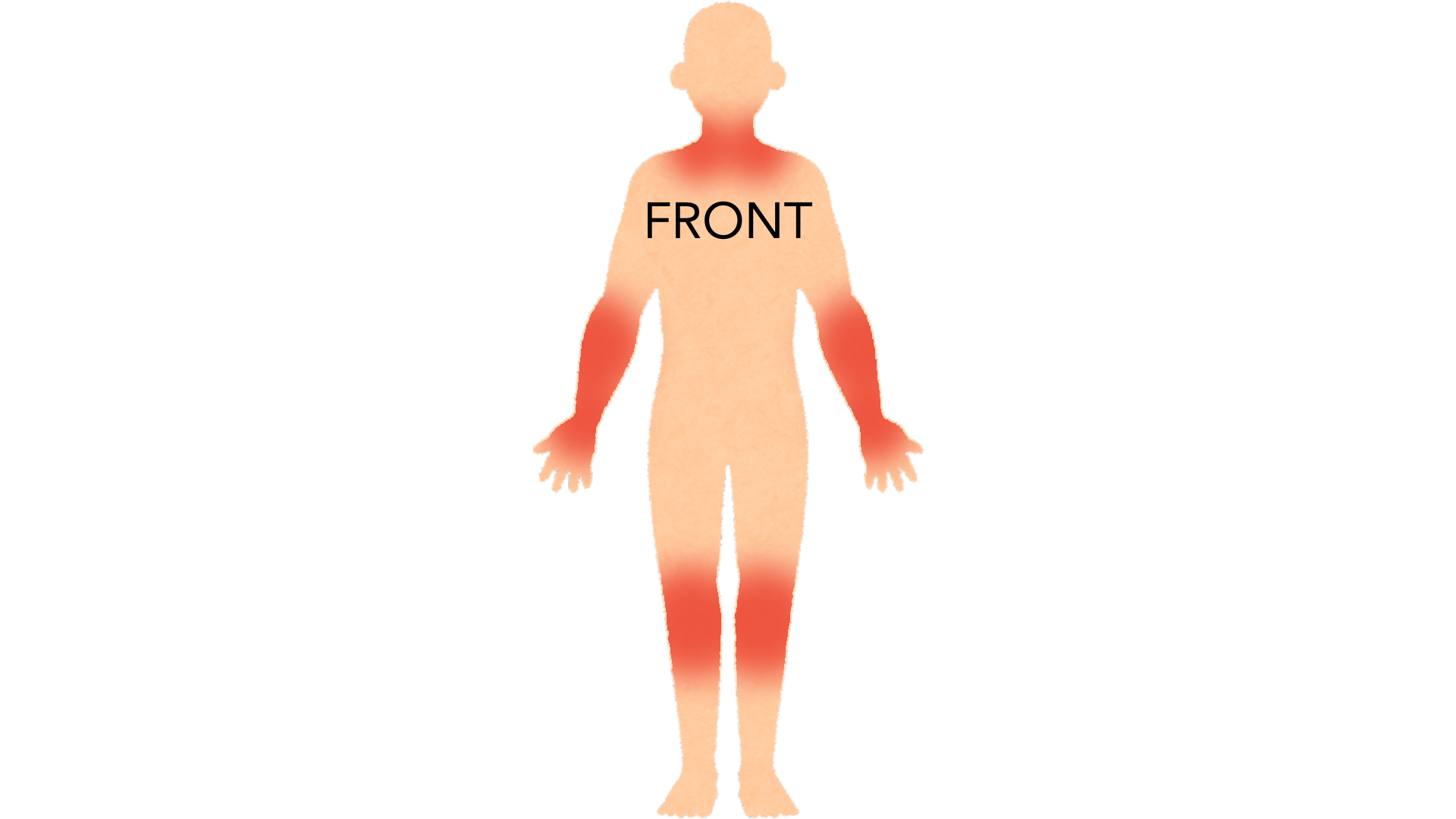 Front view of a whole body with red marks in the creases of both elbows, behind both knees, on both sides of the neck and on both wrists.