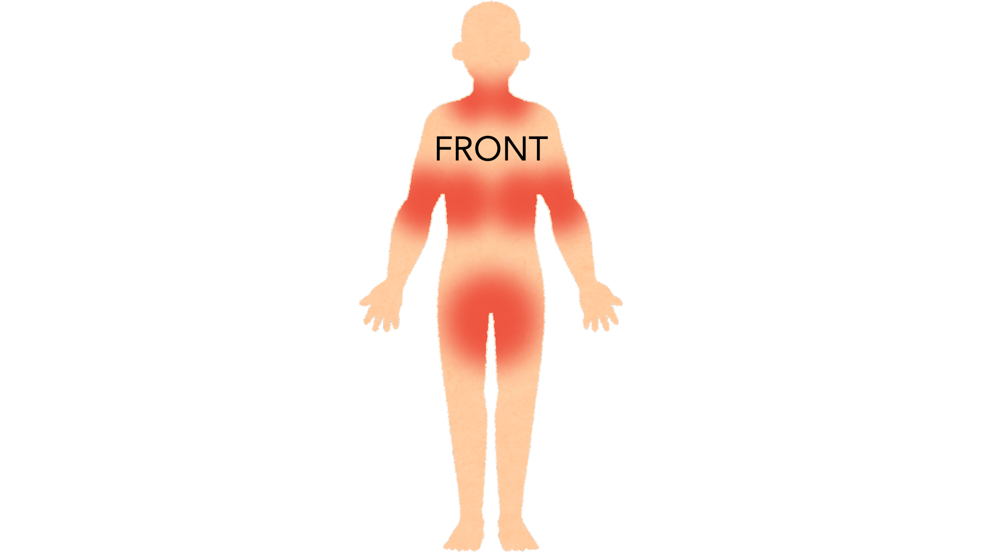 Front view of a whole body with red marks on both sides of the neck, in both armpits, under both breasts and across the groin.