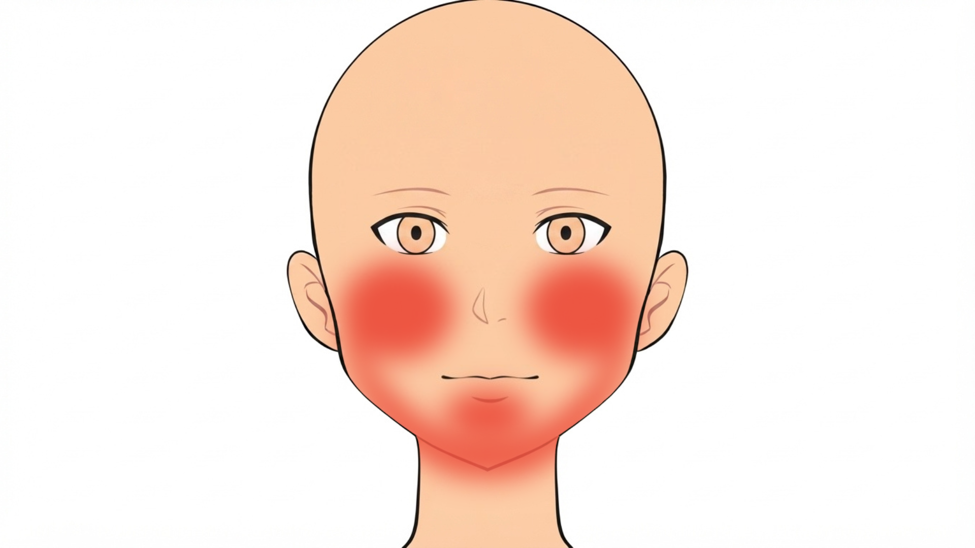 Front view of a head with red marks on both cheeks, along both sides of the jaw and on the chin.